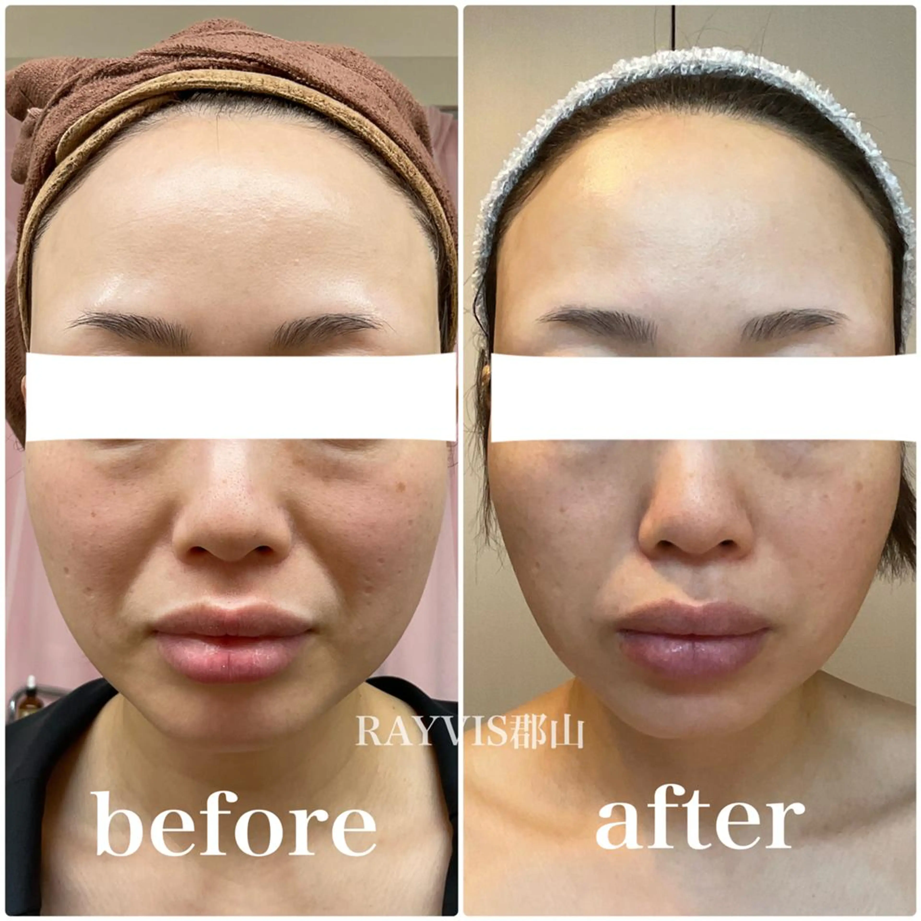 🩵RAYVIS🩵 郡山店のエステ・リラクイメージ