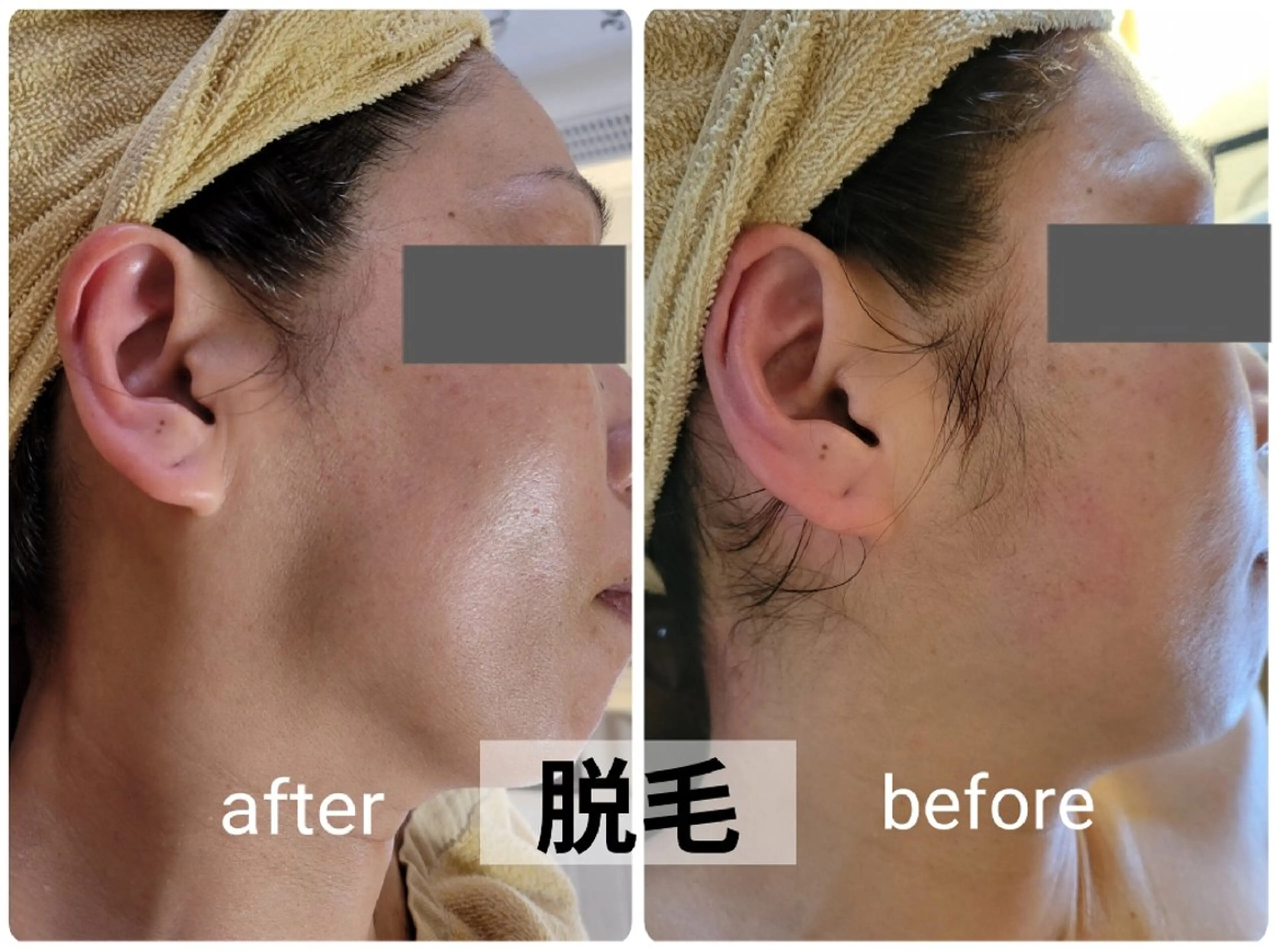 全身脱毛の写真