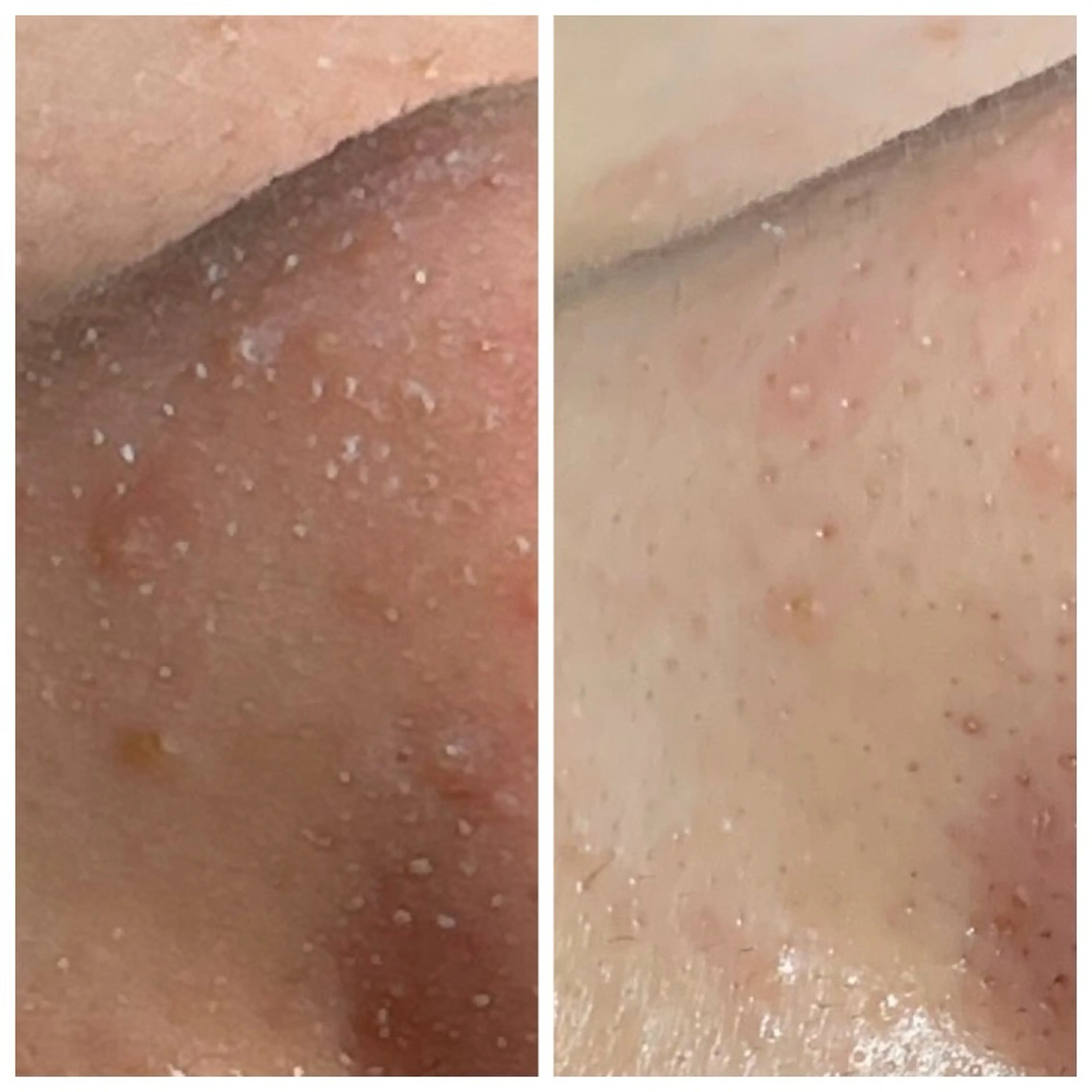 《初回限定》毛穴洗浄の写真