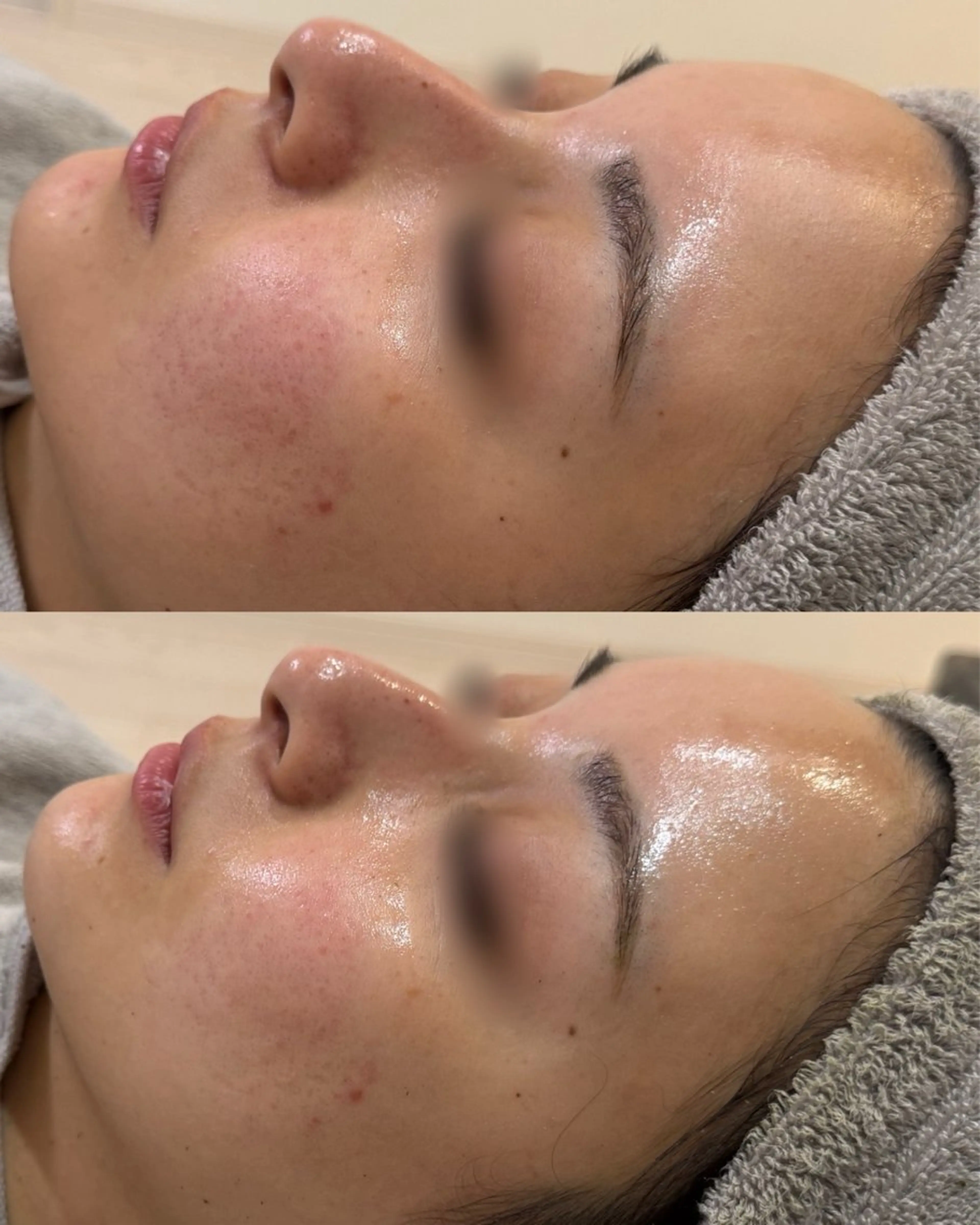 メンズ laksmi 繰り返す肌荒れ専門のエステ・リラクイメージ