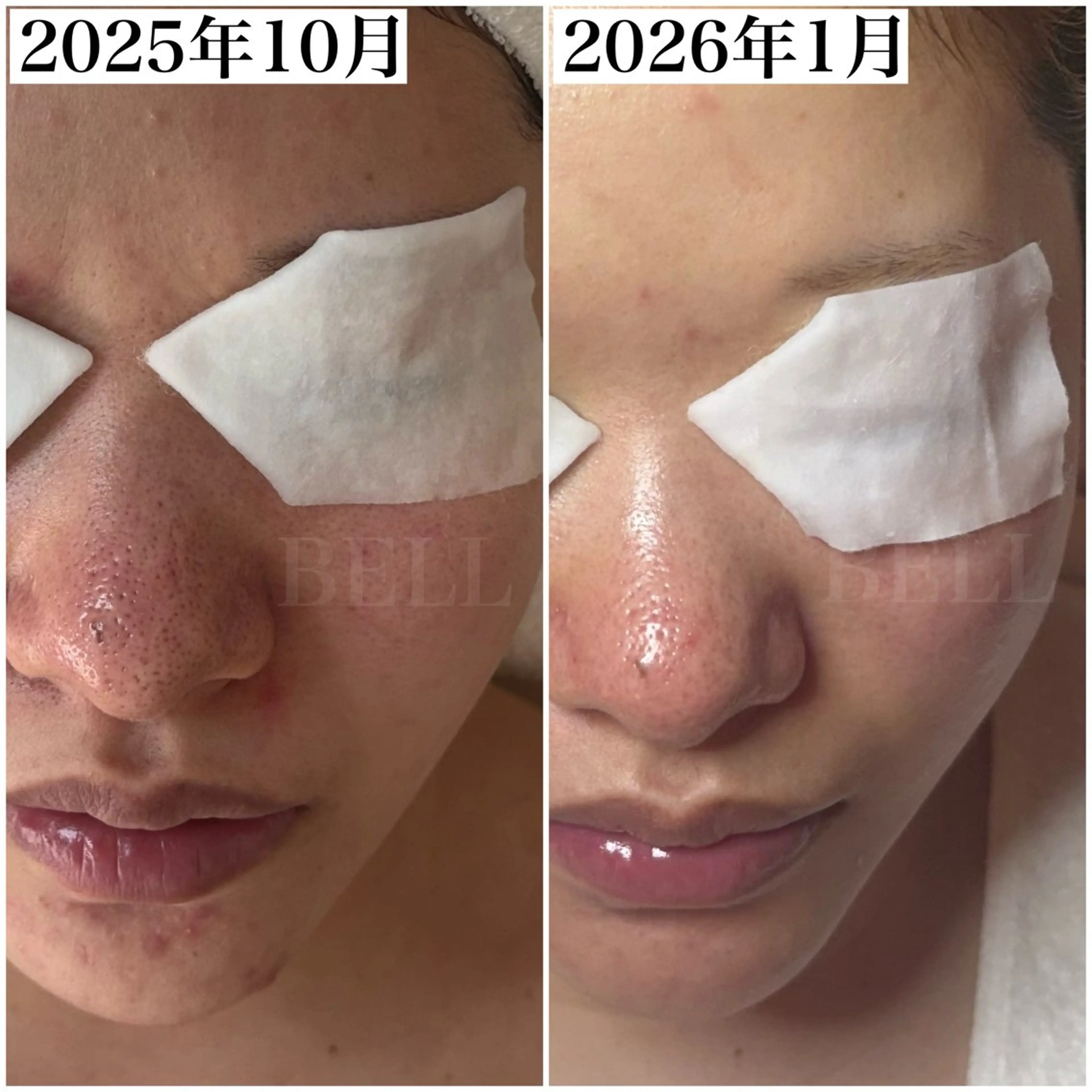 【人気No.1毛穴黒ずみ集中ケア】デコルテ＋ヘッドスパ付 90分 通常料金13,000円の写真