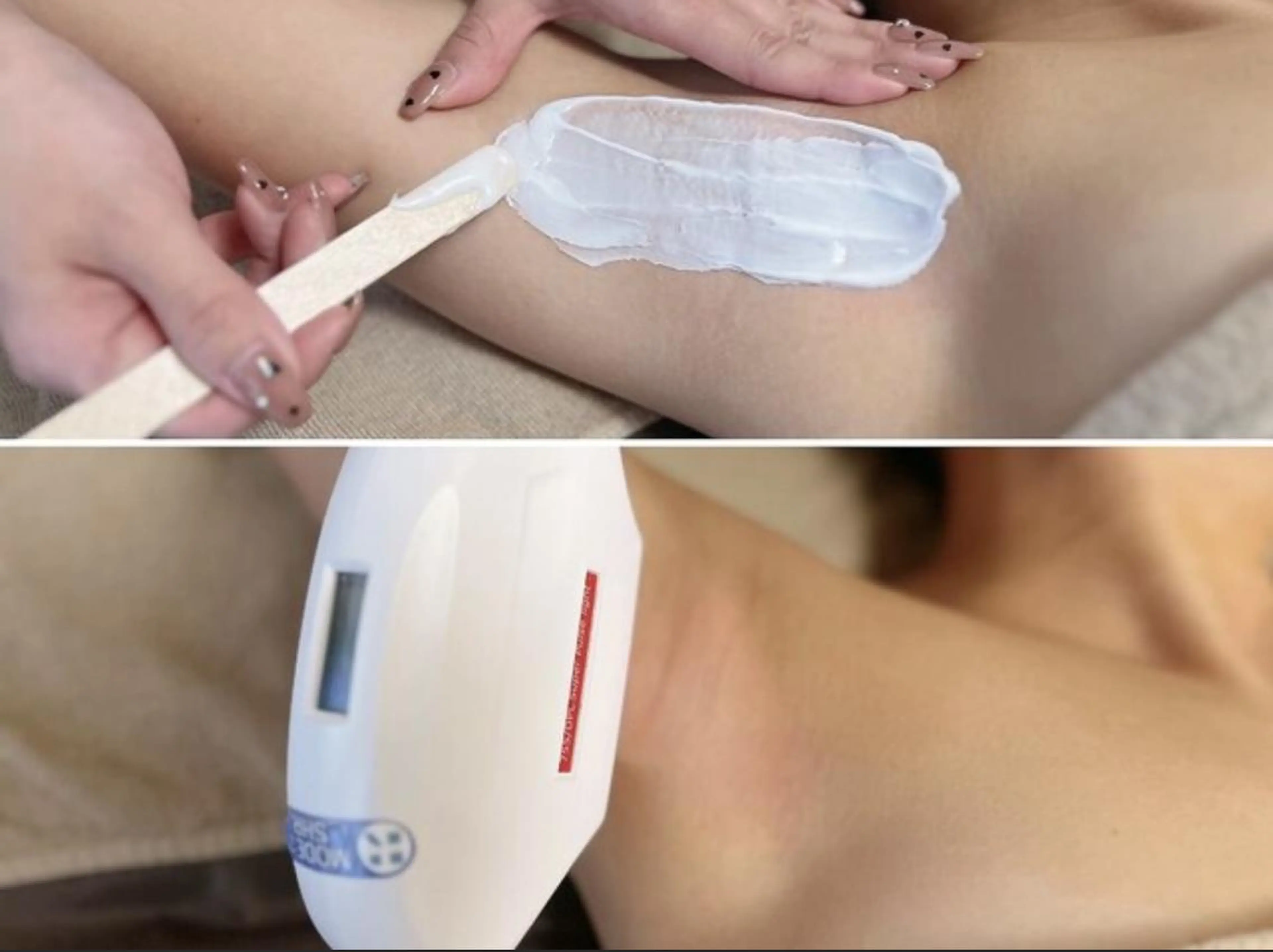 【わきMIX脱毛(光脱毛+WAX)】¥8000→¥4000の写真