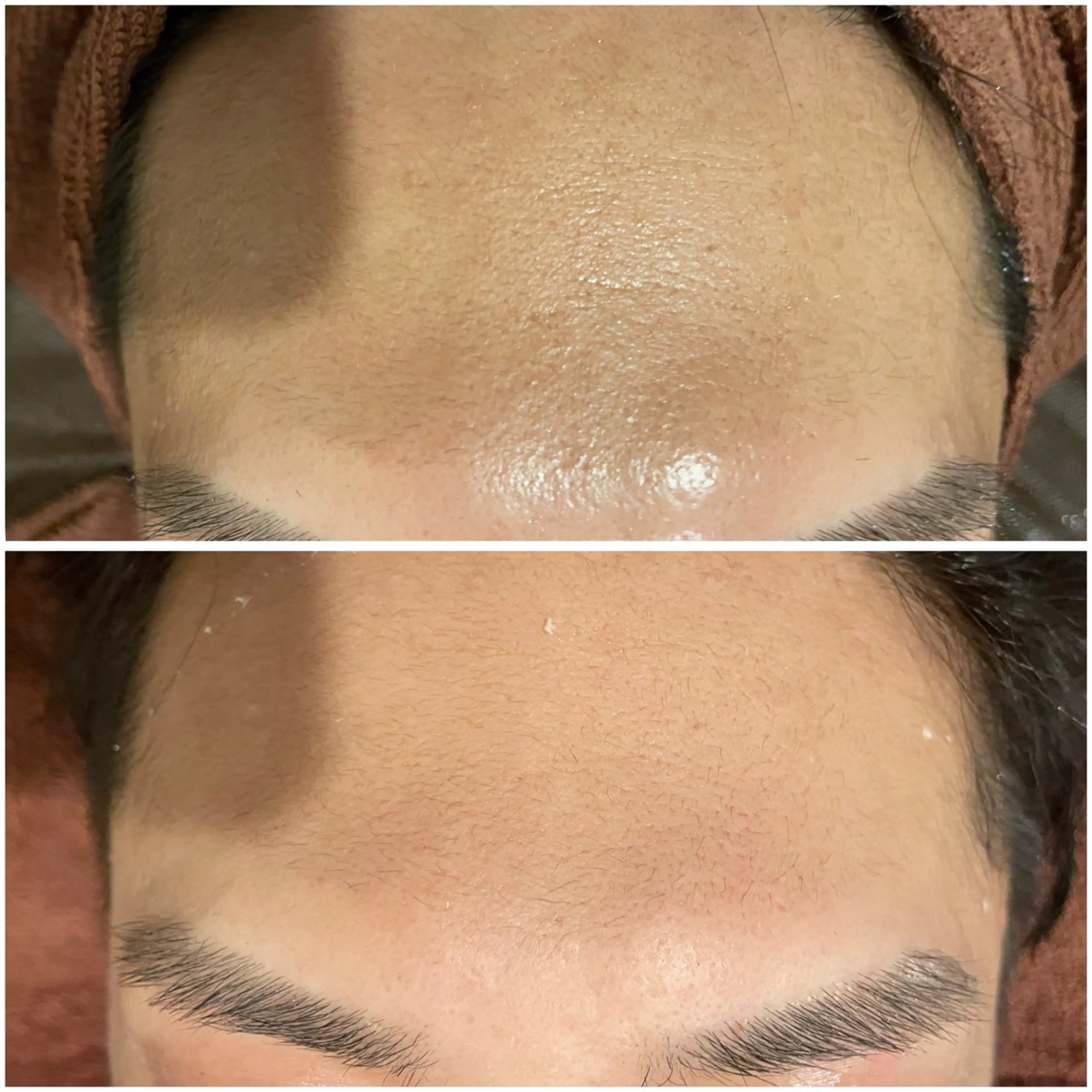 エステ リラク ニキビ特化型エステ 🍓最短で肌質改善のその他イメージ