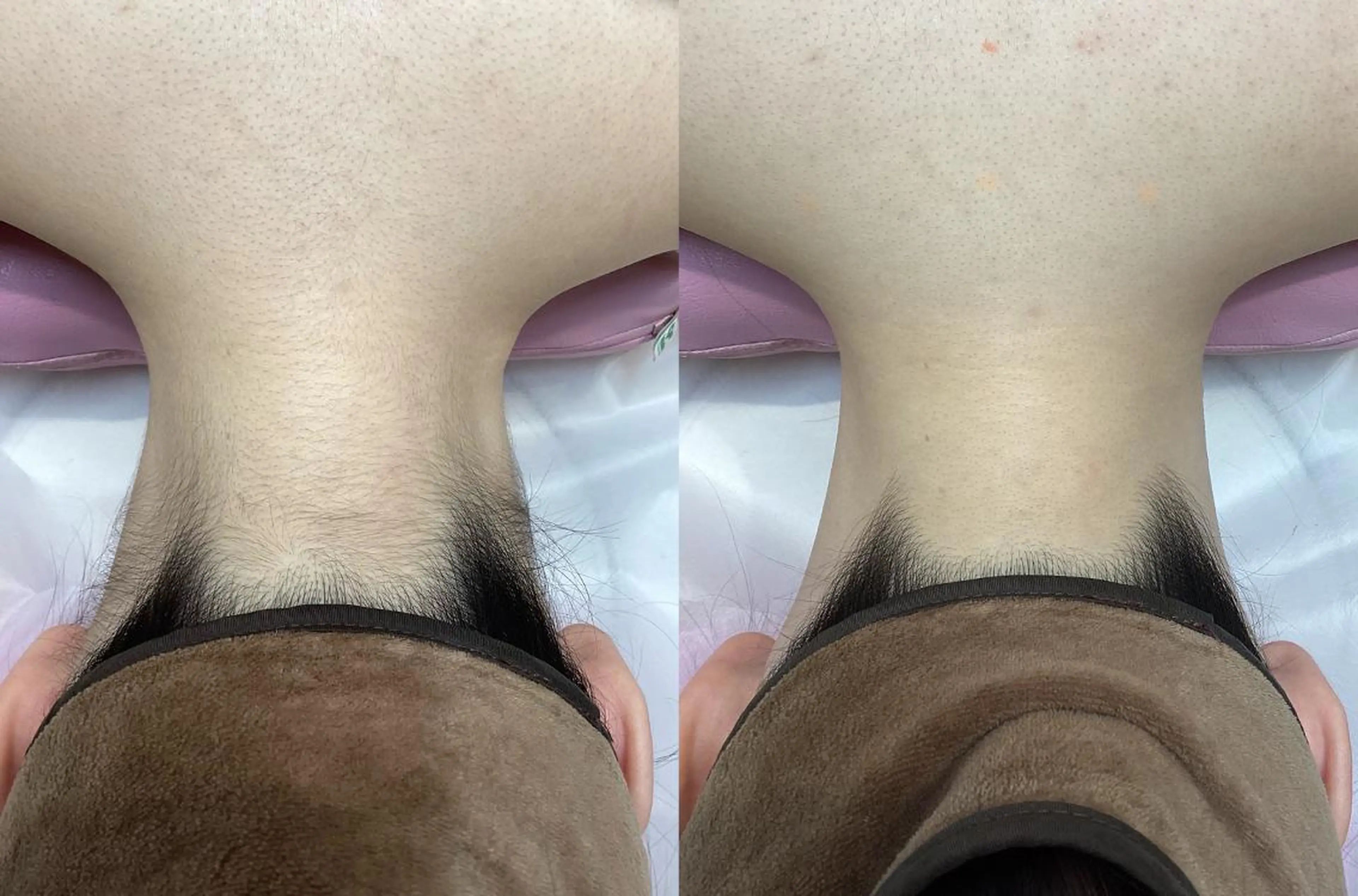 💎脱毛初心者限定💎🎀シェービング付きうなじ脱毛🎀✨RAYVIS自慢の2段階シェービングで仕上がり抜群✨の写真