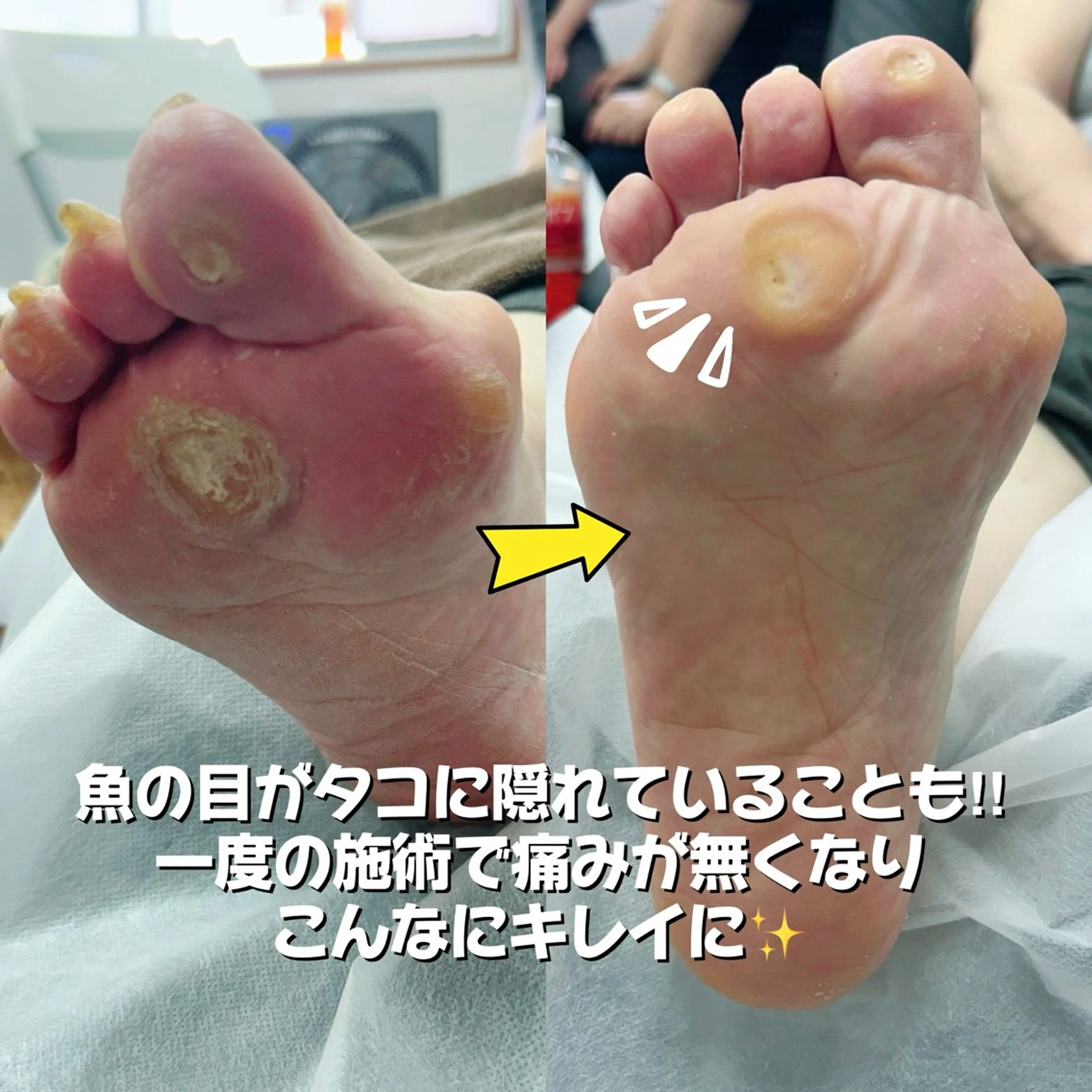 その他 巻き爪フットケアサロンKotori所属・フットケアサロン Kotoriのその他イメージ