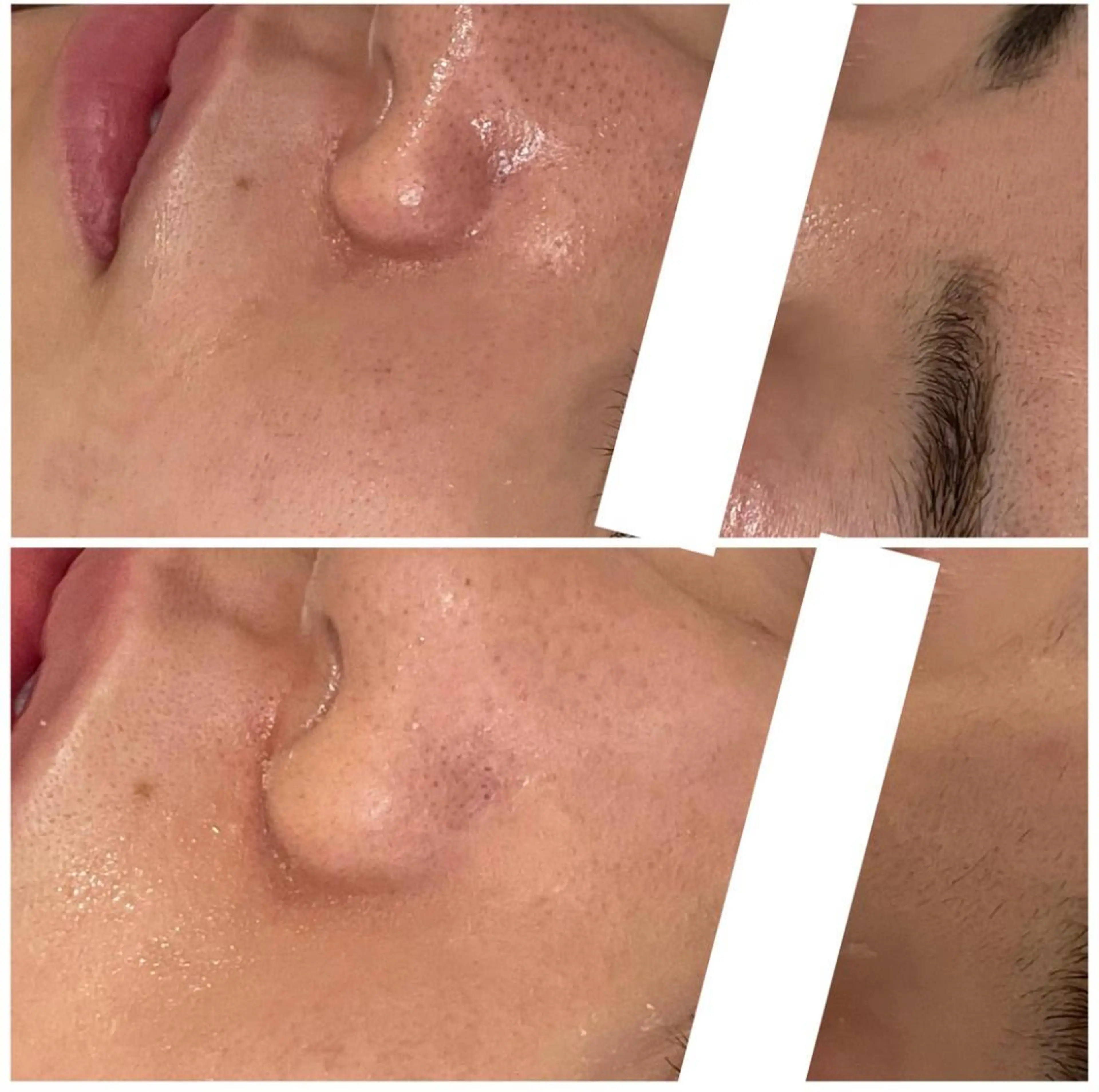 ニキビ特化型エステ 🍓最短で肌質改善のエステ・リラクイメージ