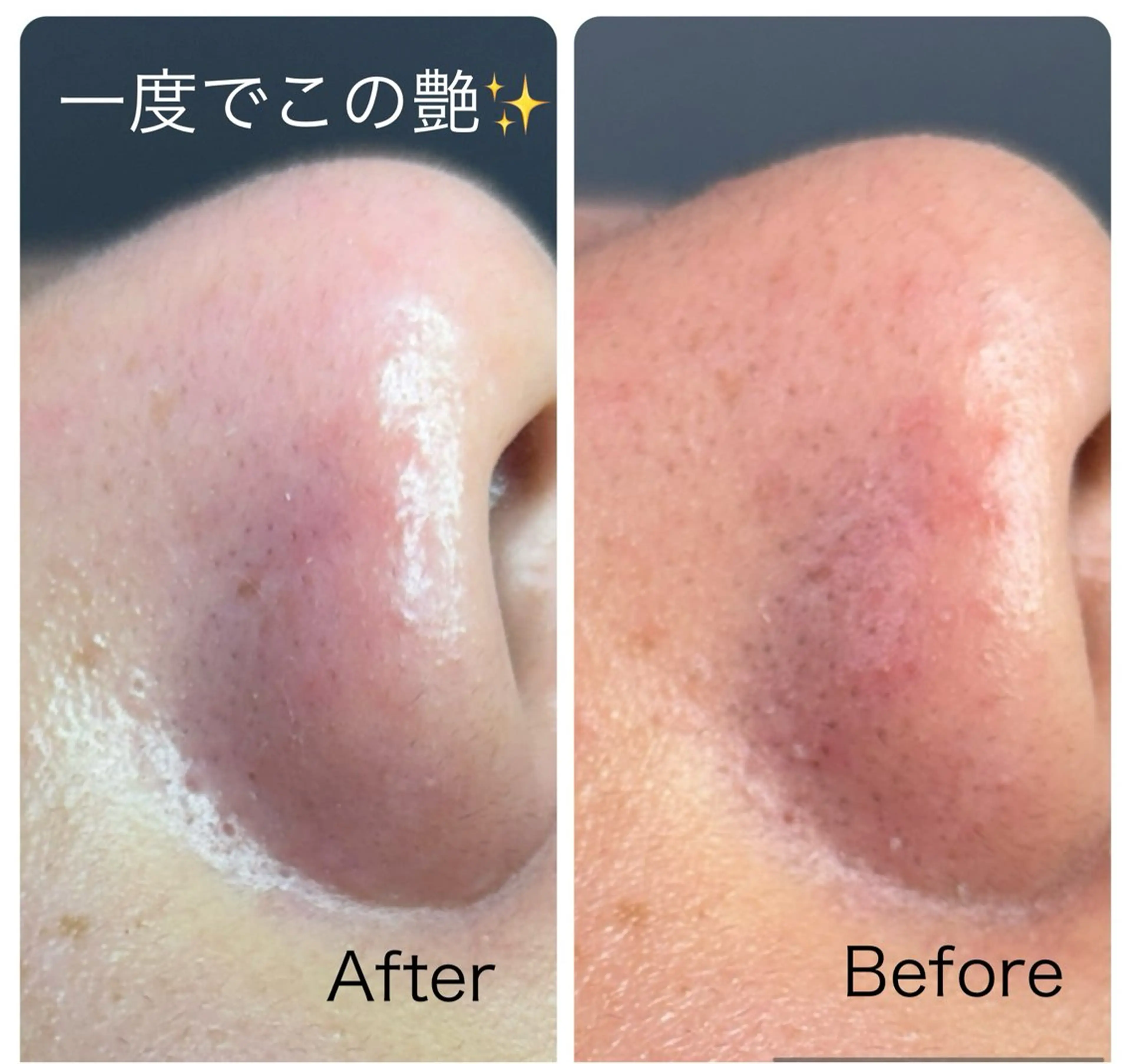 気穴エクストラクション、いちご鼻、ざらつき、黒いポツポツ1度で解消！毛穴引き締めパックで整えますの写真