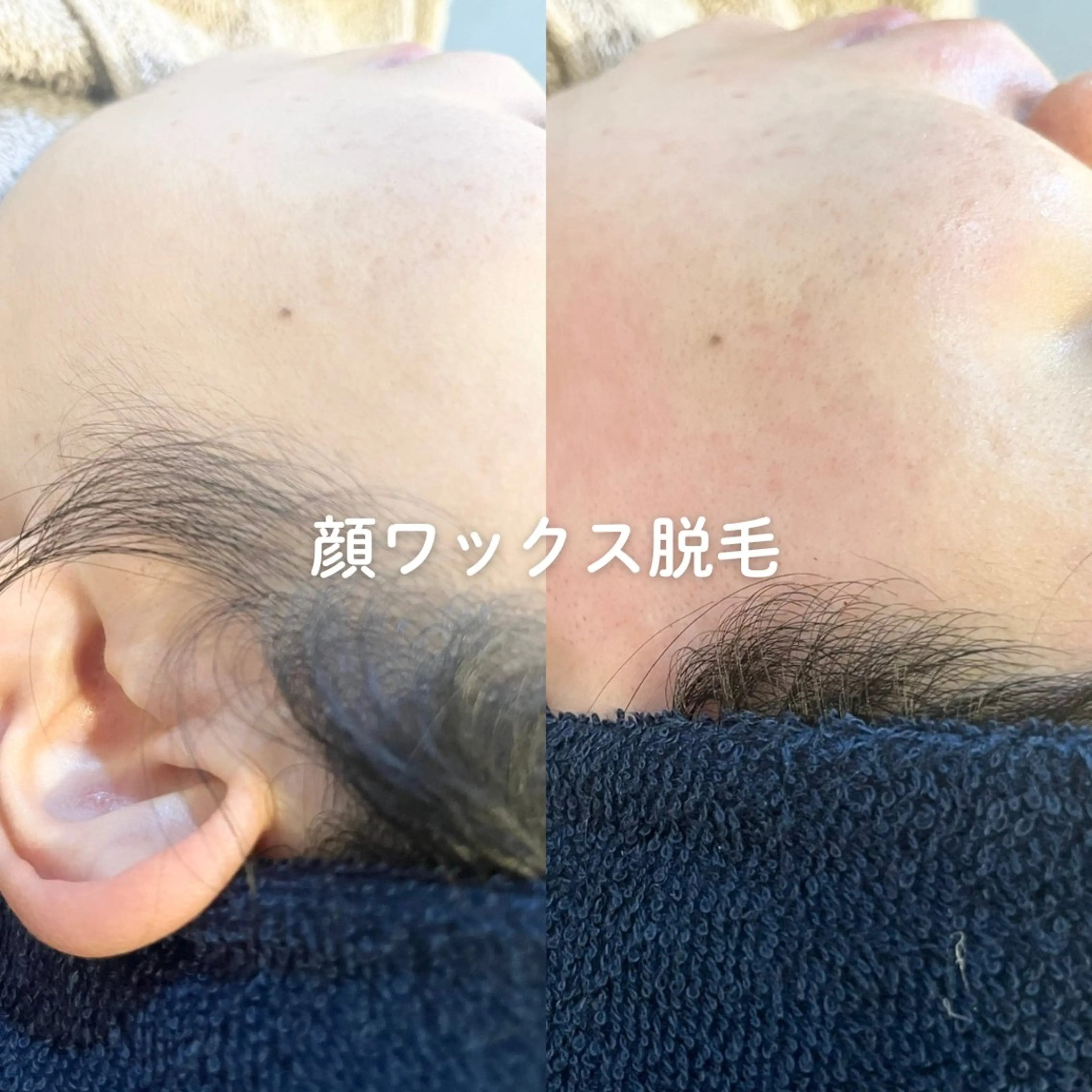 EST BEAUTY所属・顔ワックス脱毛/ ハーブピーリングのエステ・リラクイメージ