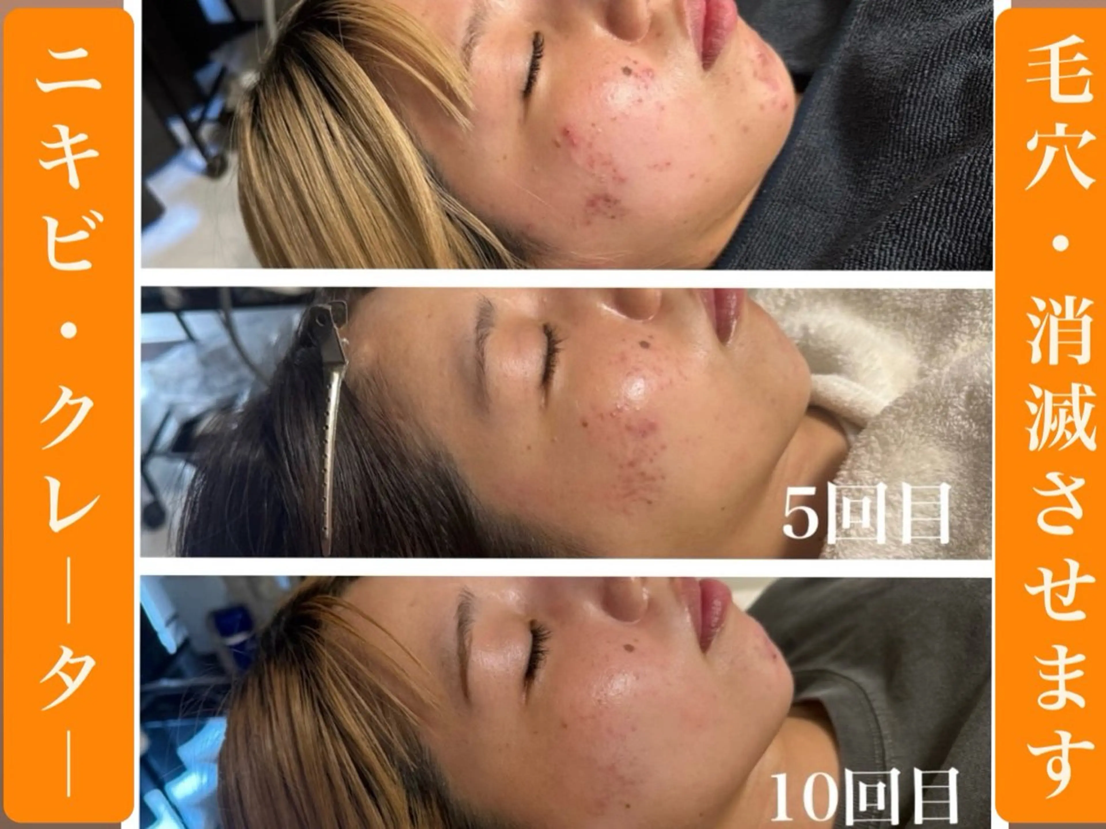 小顔・毛穴/ニキビ/ ハーブピーリング専門のエステ・リラクイメージ