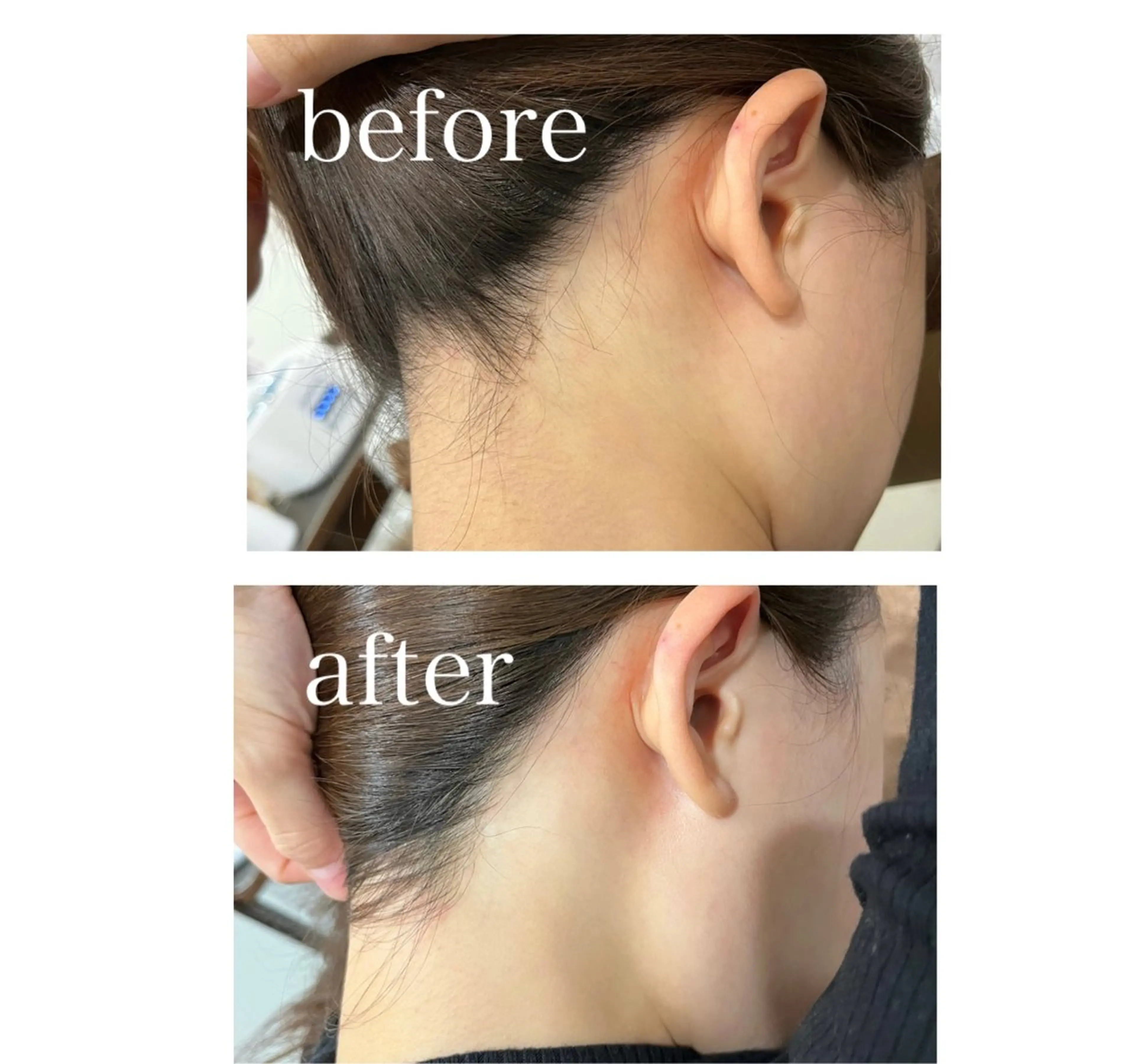 まるで元から生えてなかったかの様な"うなじ脱毛"の写真