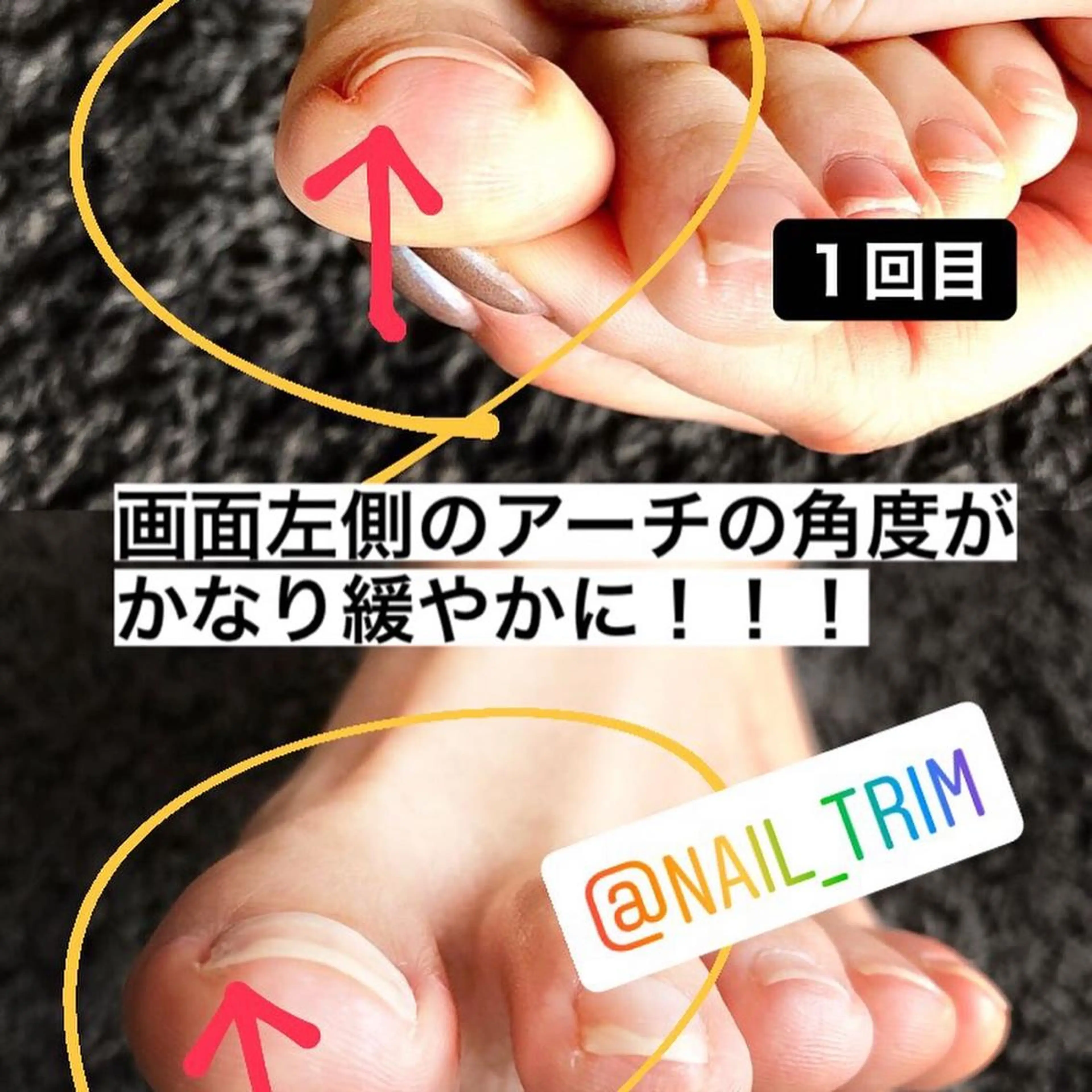 痛くない　巻き爪ケア✨５指フットケアサービス付き❣️  スパリチュアルオイルで保湿お仕上致します😊※利用条件は詳細必読の写真