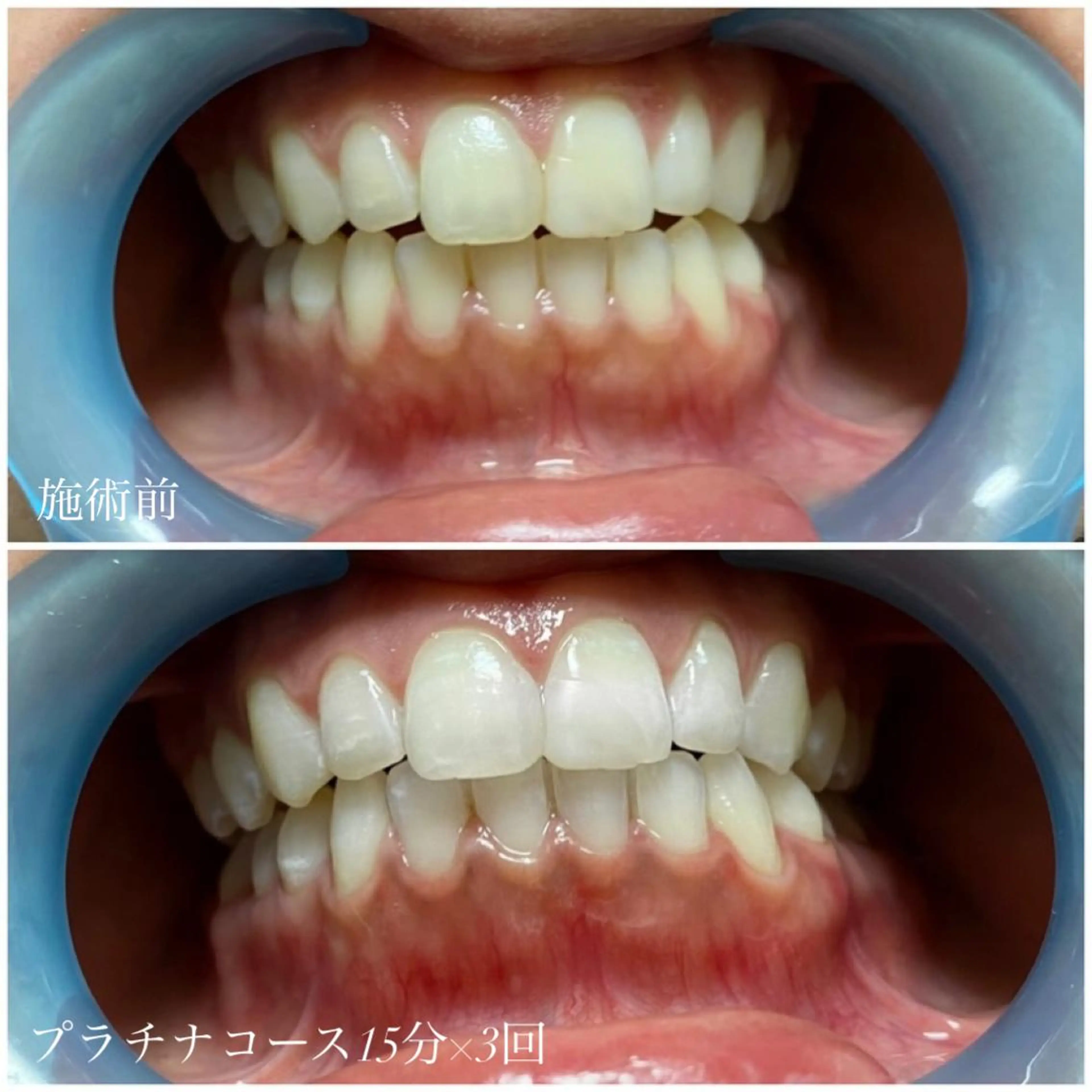 ネイル/耳つぼ /新ホワイトニングのネイルデザイン