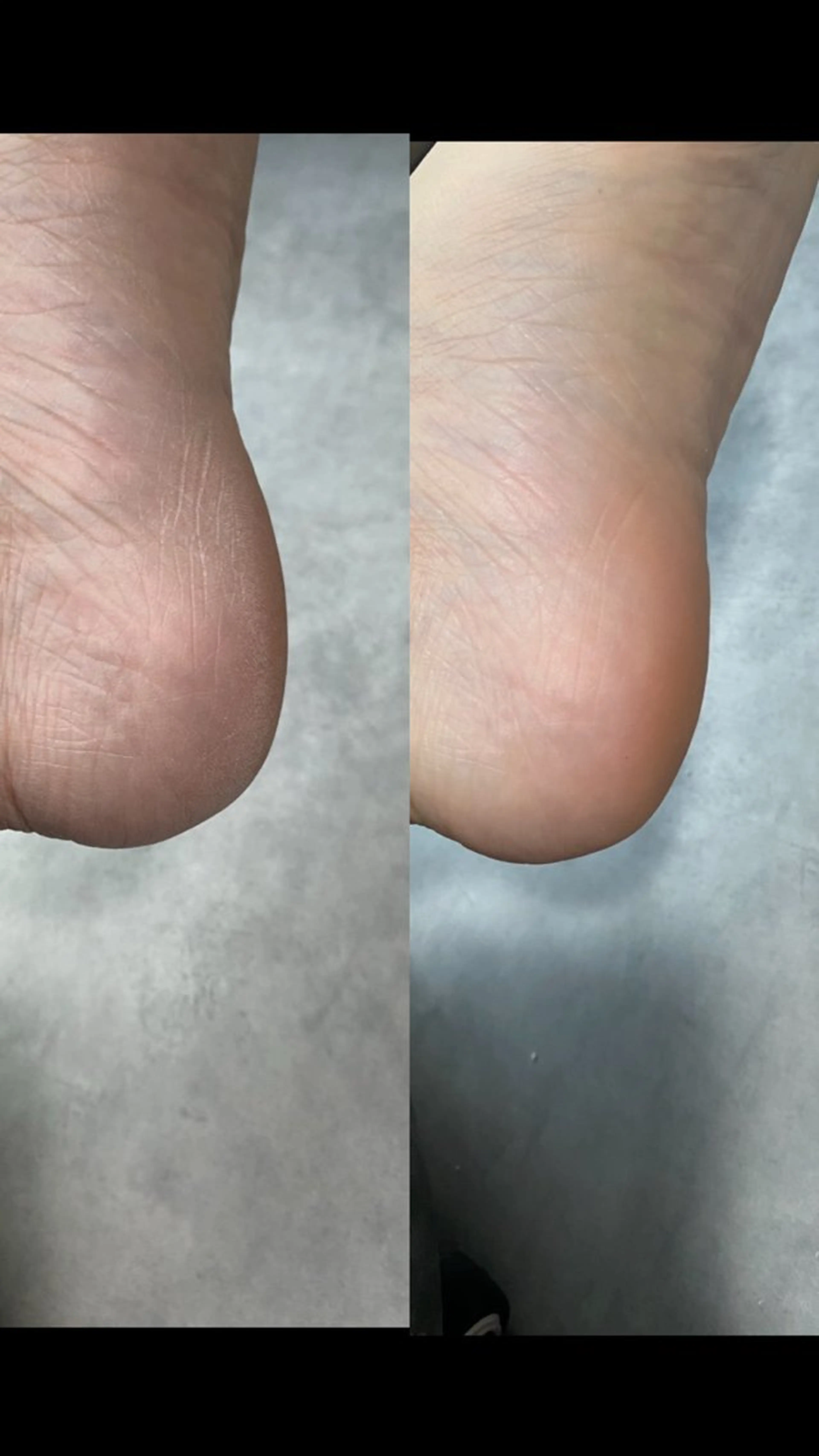 フット足裏角質ケアの写真