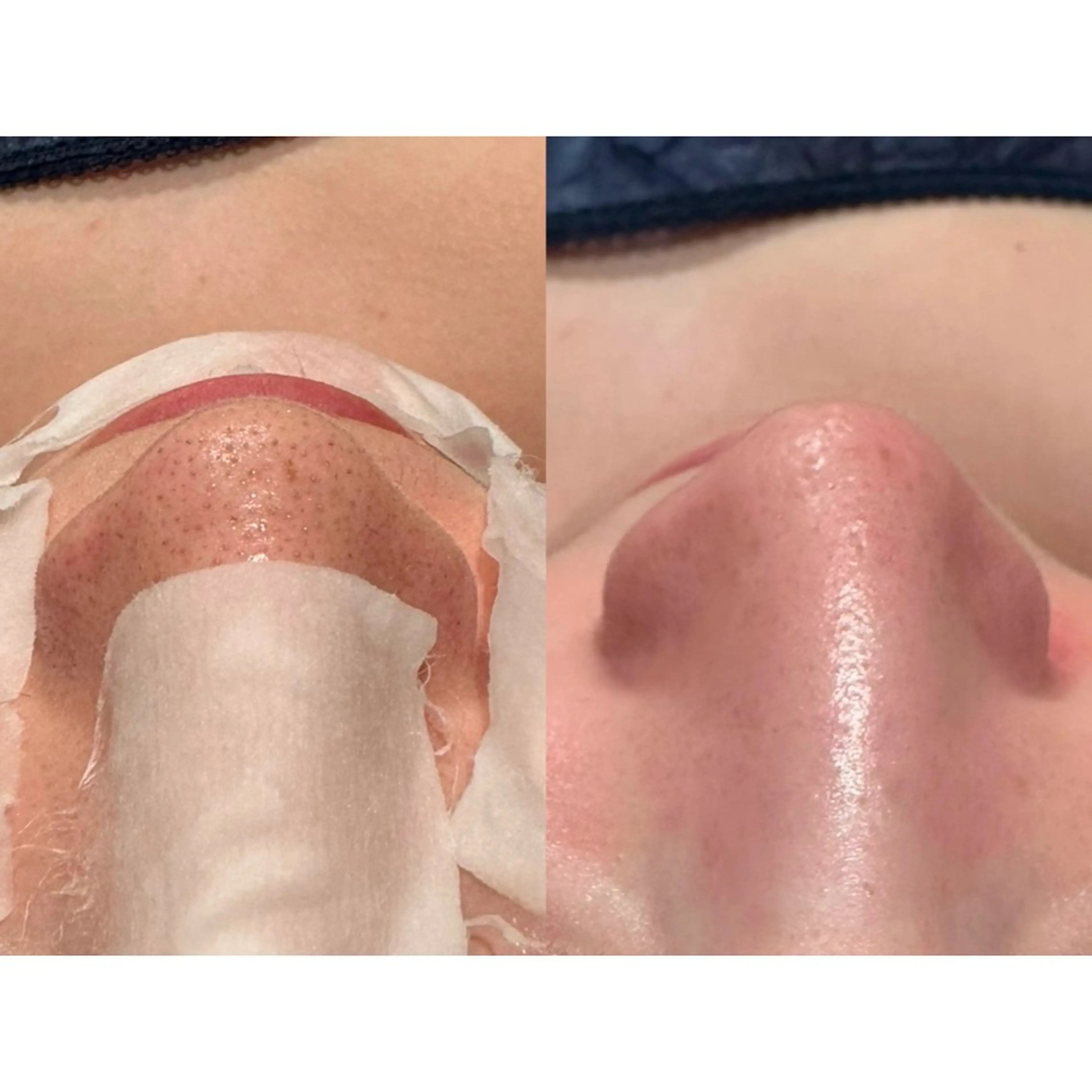 【ツルツル美肌&小顔引締めしたい方はコレ★】ハイドラフェイシャル＋美顔器パスリルの写真