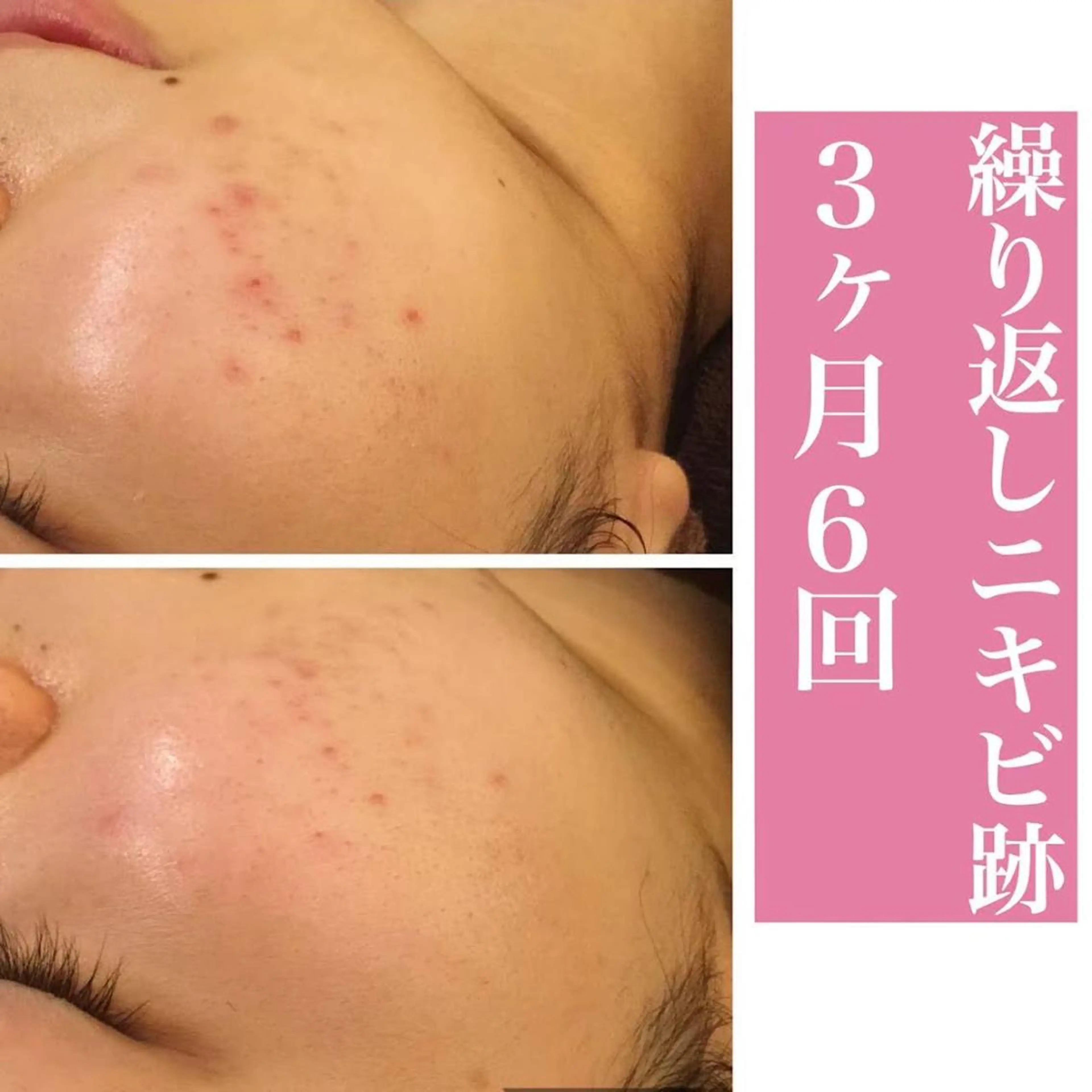 ロング カラー パーマ ヘアアレンジ メンズ キッズ ネイル マツエク・マツパ 都内で出来る肌管理！ 最短ニキビ改善のエステ・リラクイメージ