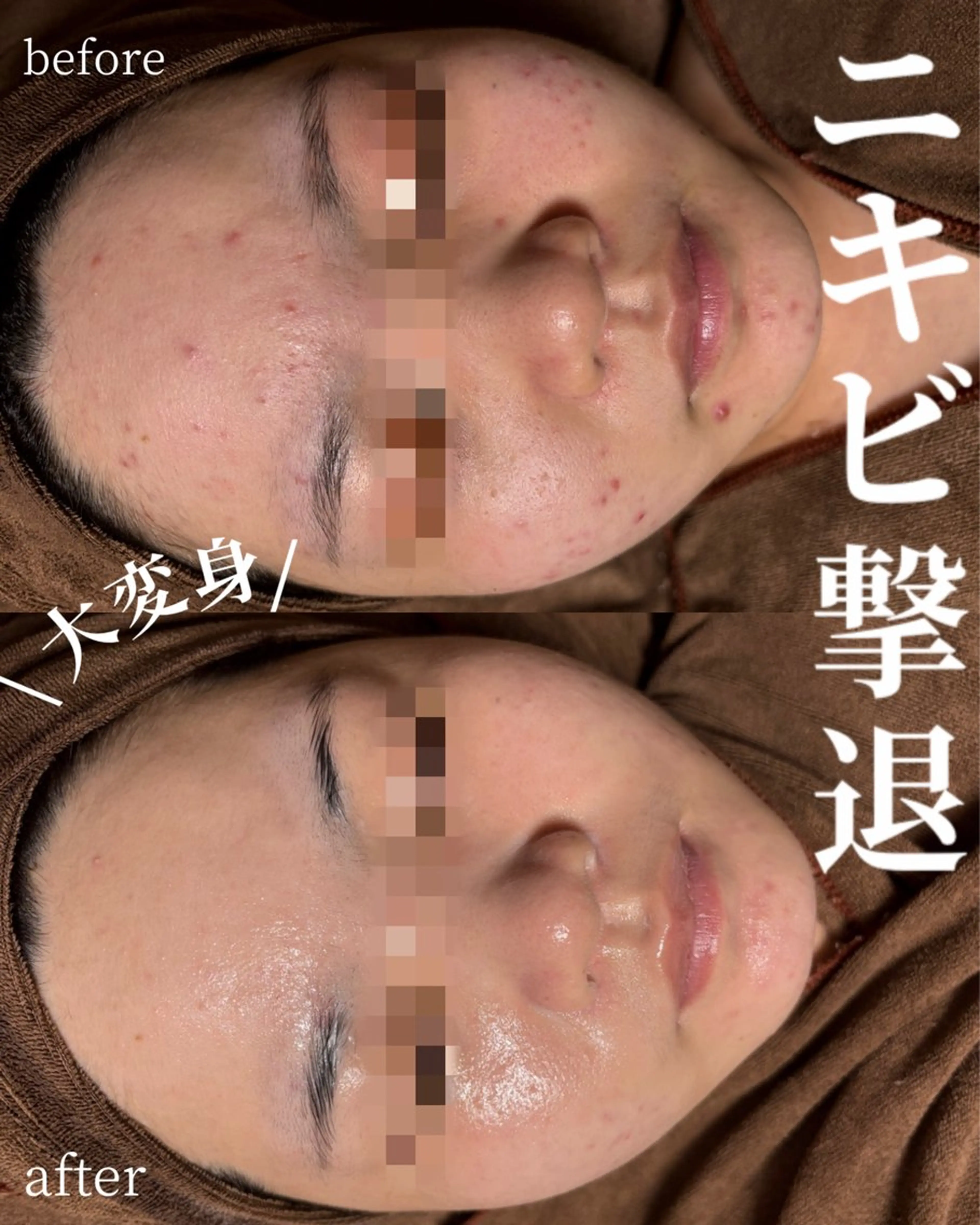 HINANO矢場町店【ヒナノ】所属・脱毛/肌改善🌿 HINANO 村田のエステ・リラクイメージ