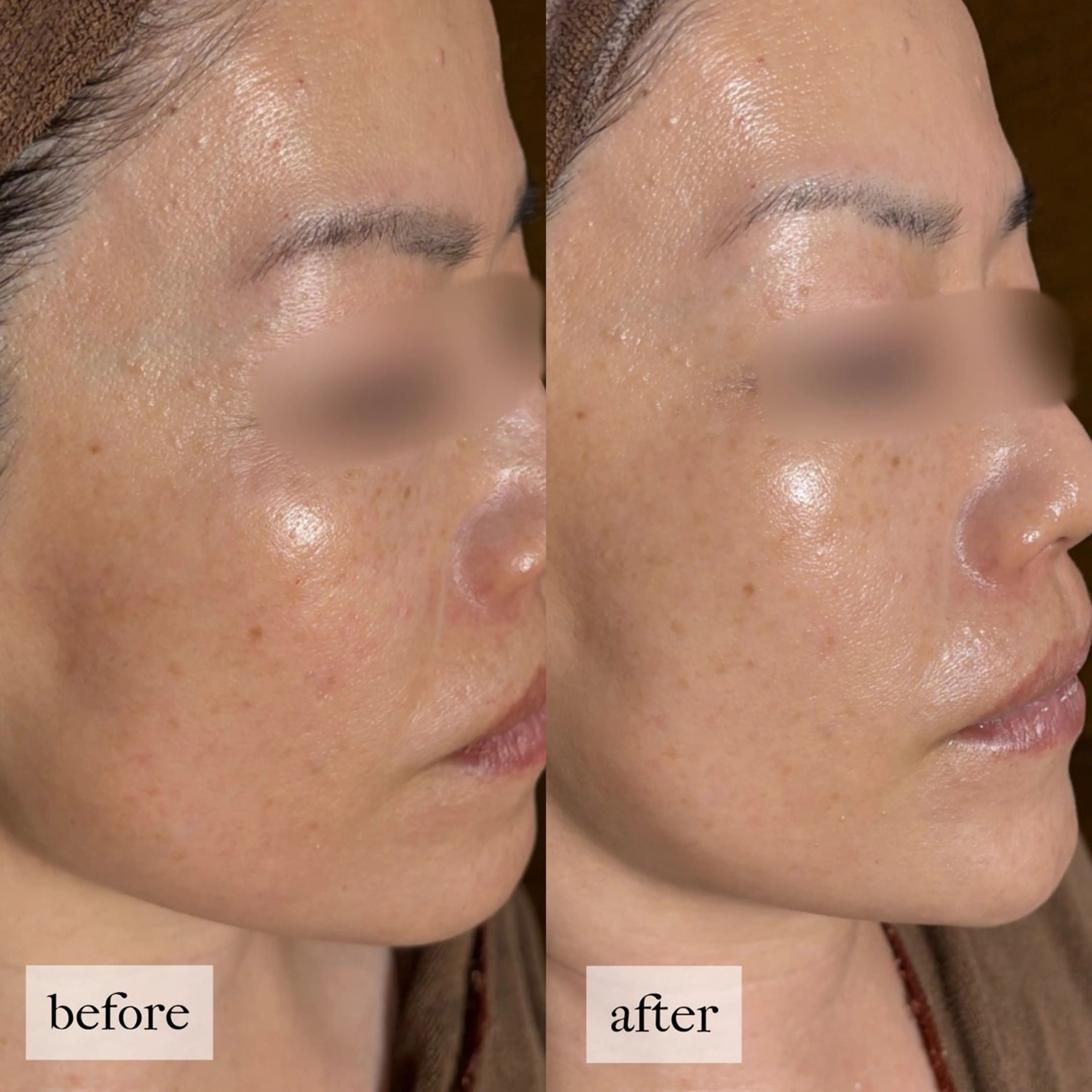 HINANO矢場町店【ヒナノ】所属・脱毛/肌改善🌿 HINANO 村田のエステ・リラクイメージ