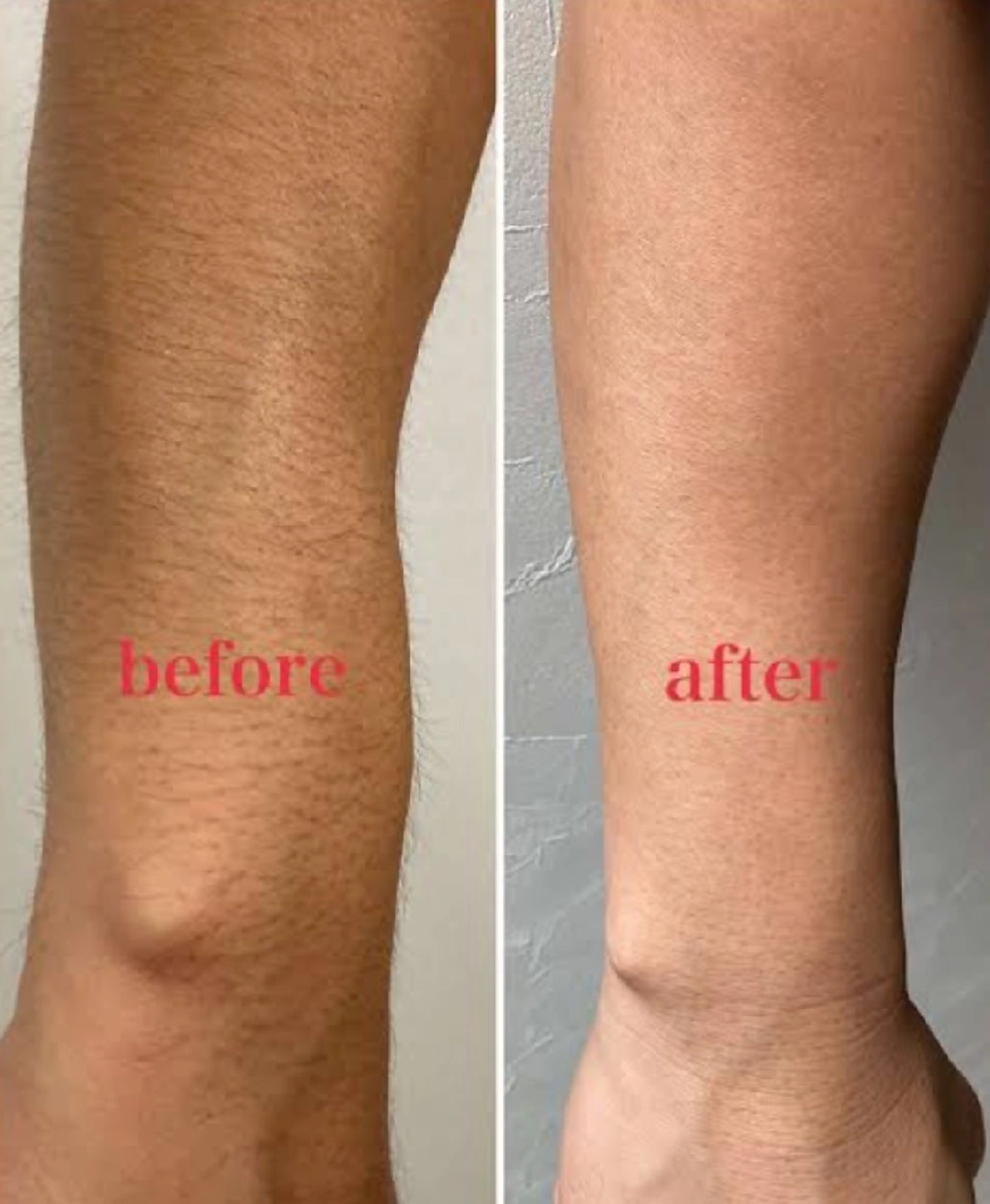 ひじ下(うで)脱毛✨の写真