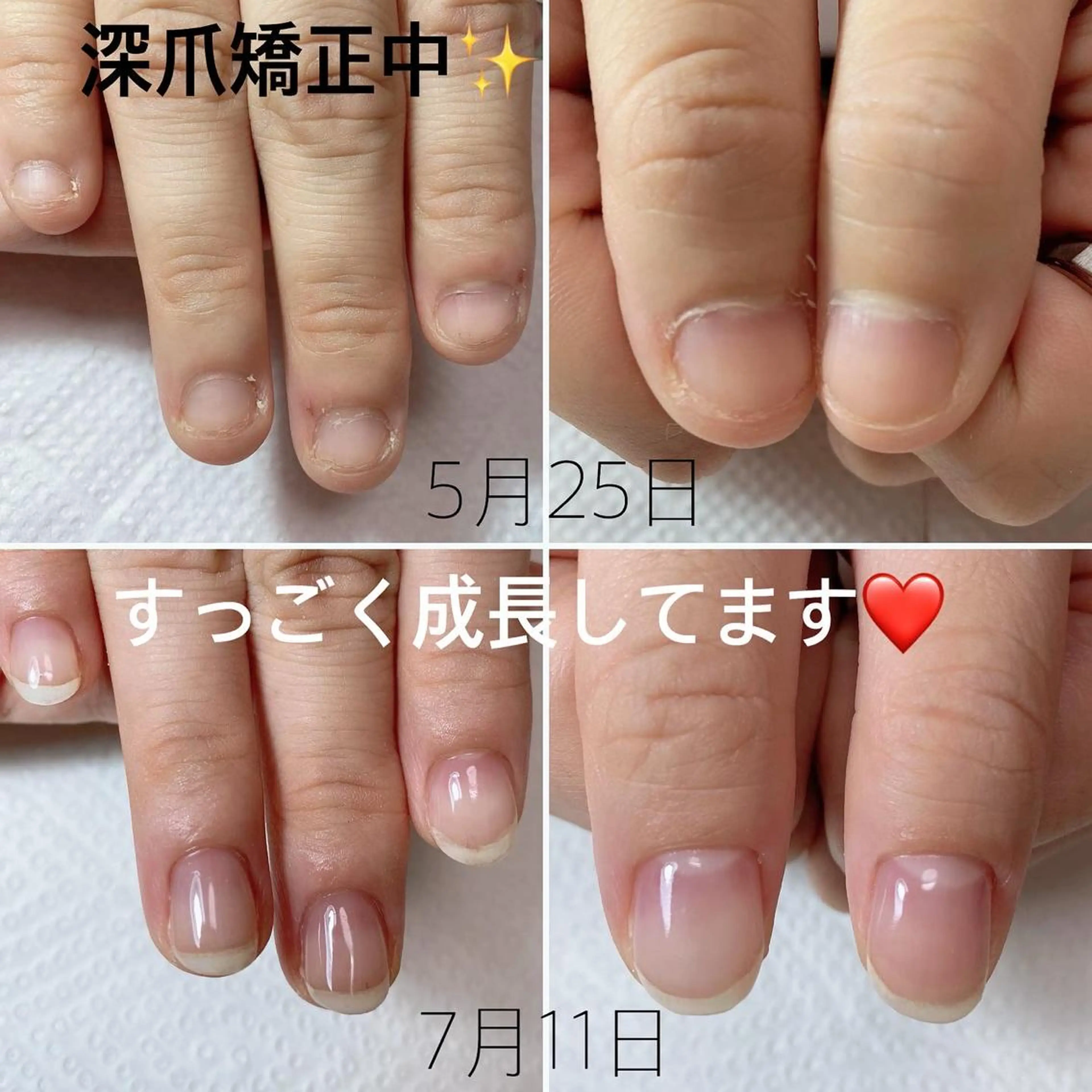 深爪矯正の写真