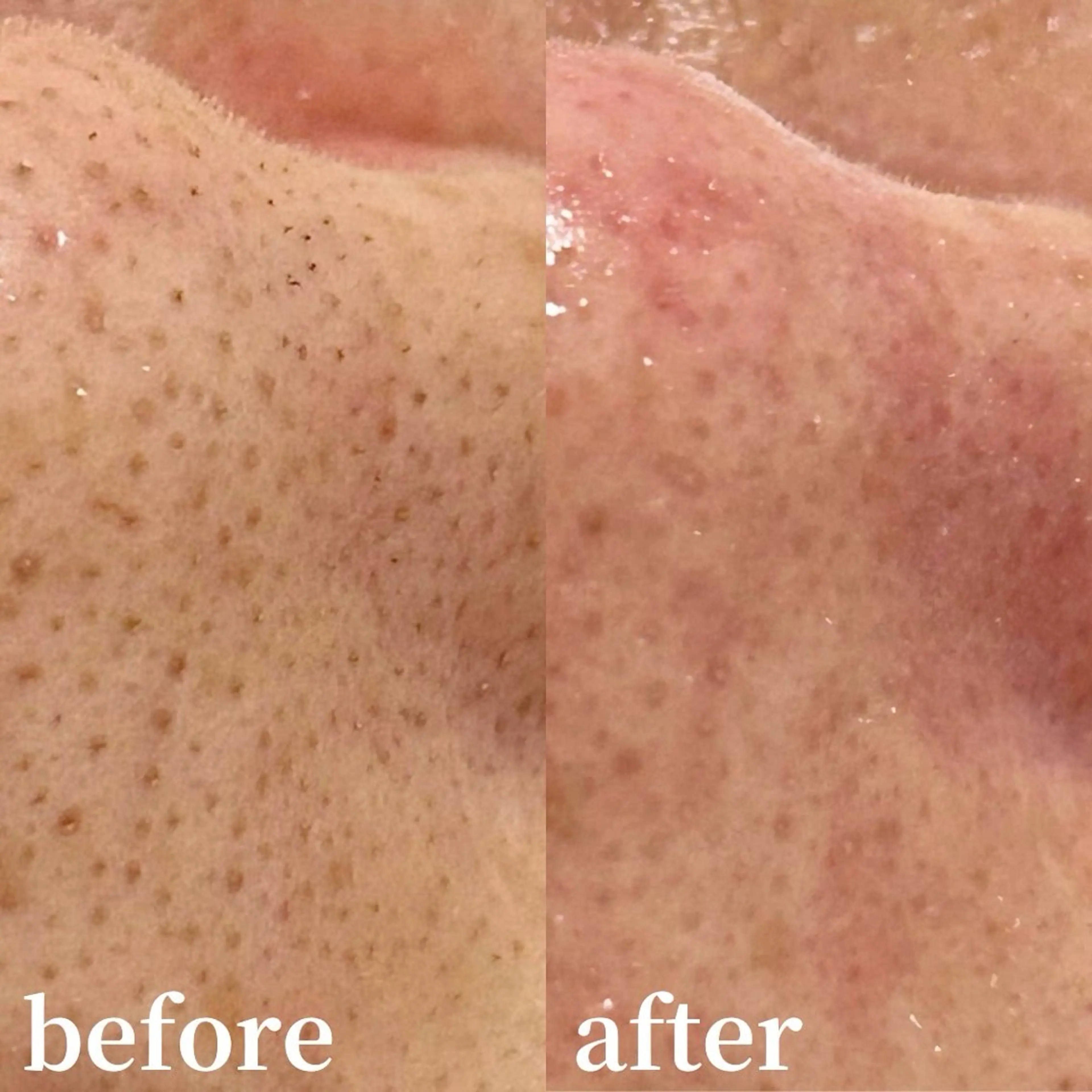 【毛穴悩みに！一部位お試し☆毛穴エクストラクション】の写真