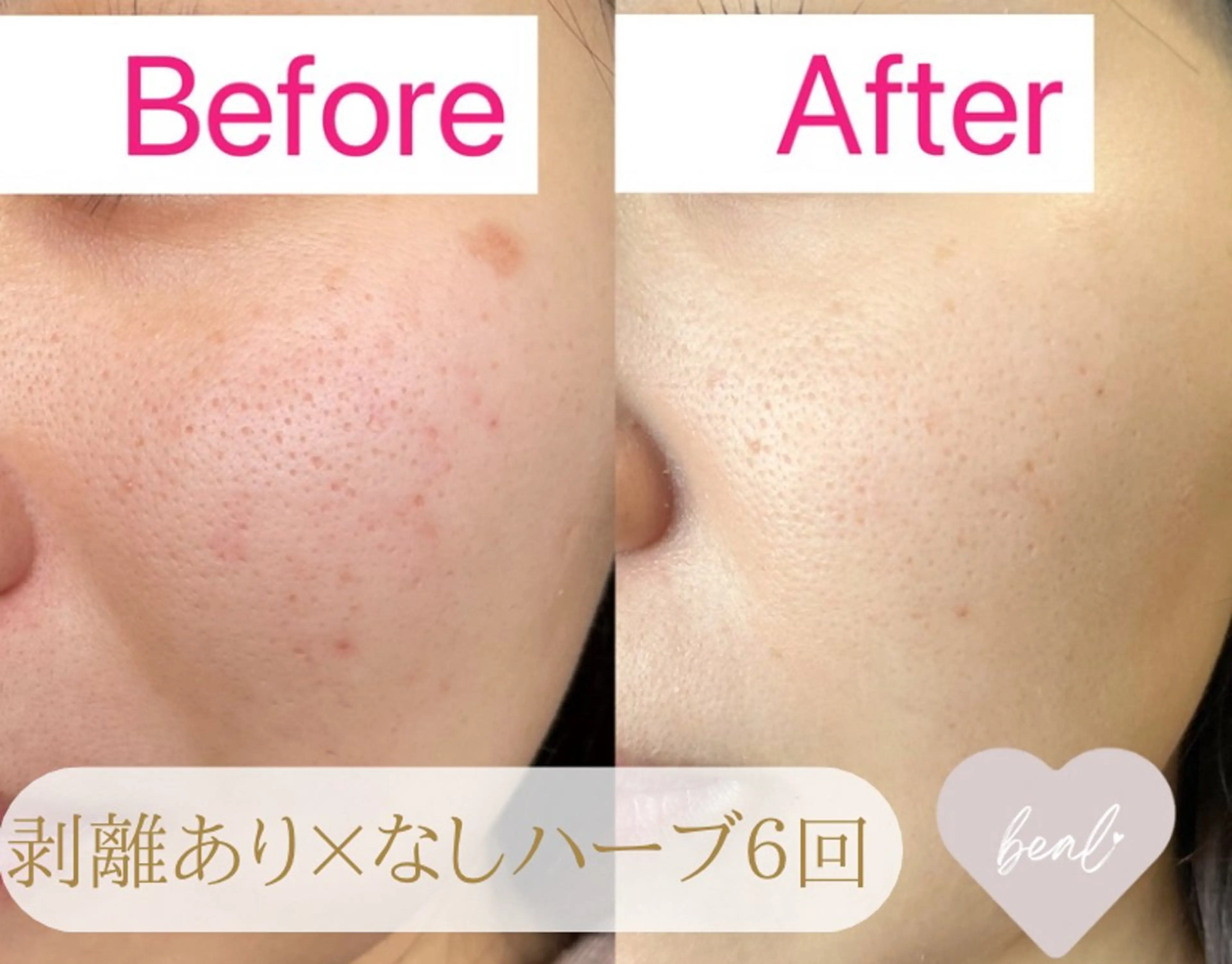 べアール所属・小顔/毛穴/ニキビ salon bealのエステ・リラクイメージ