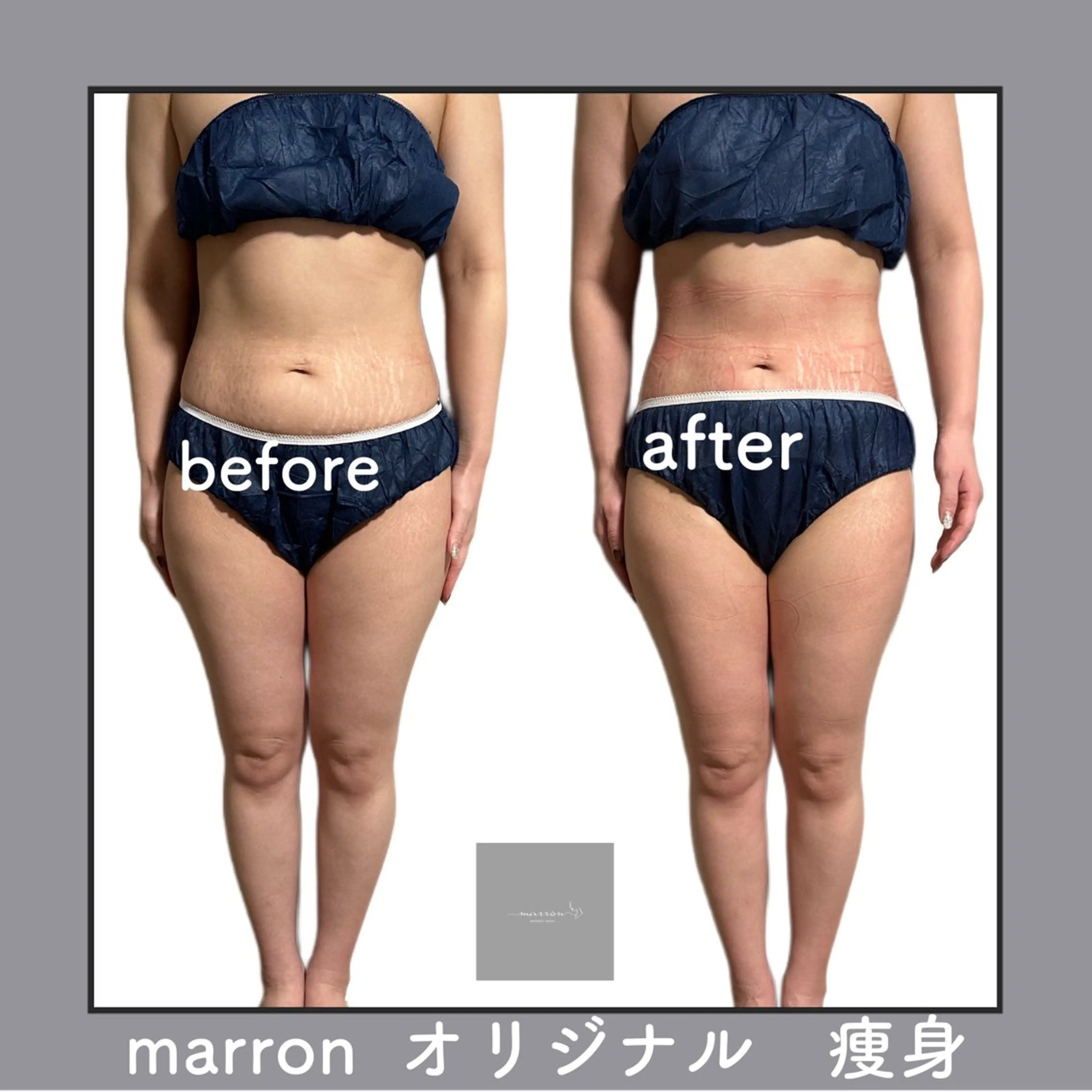 marron所属・痩身ハイパーナイフ ララピールリアボーテのエステ・リラクイメージ