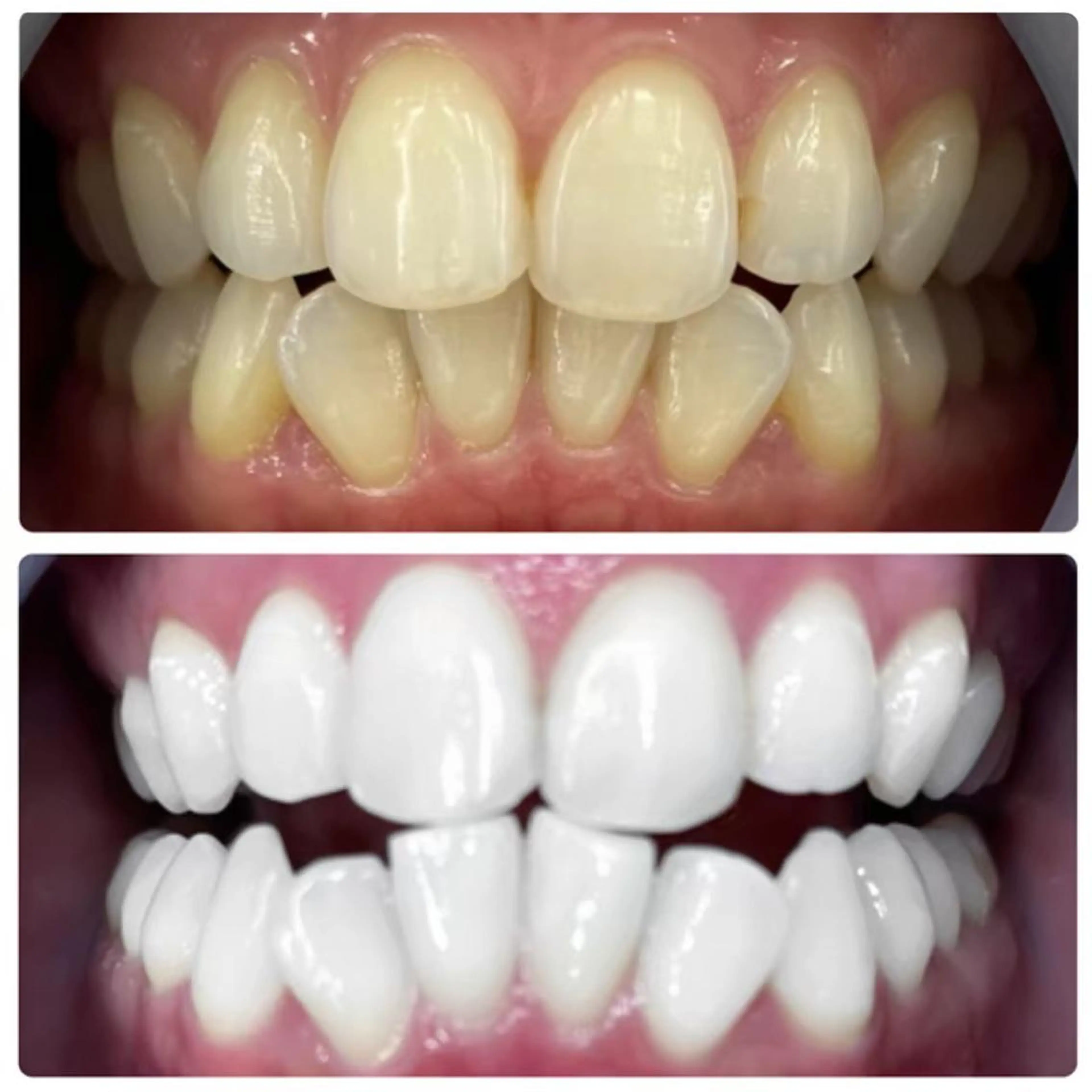 激変❕6照射【¥13,200】で白さを実感☺️✨の写真