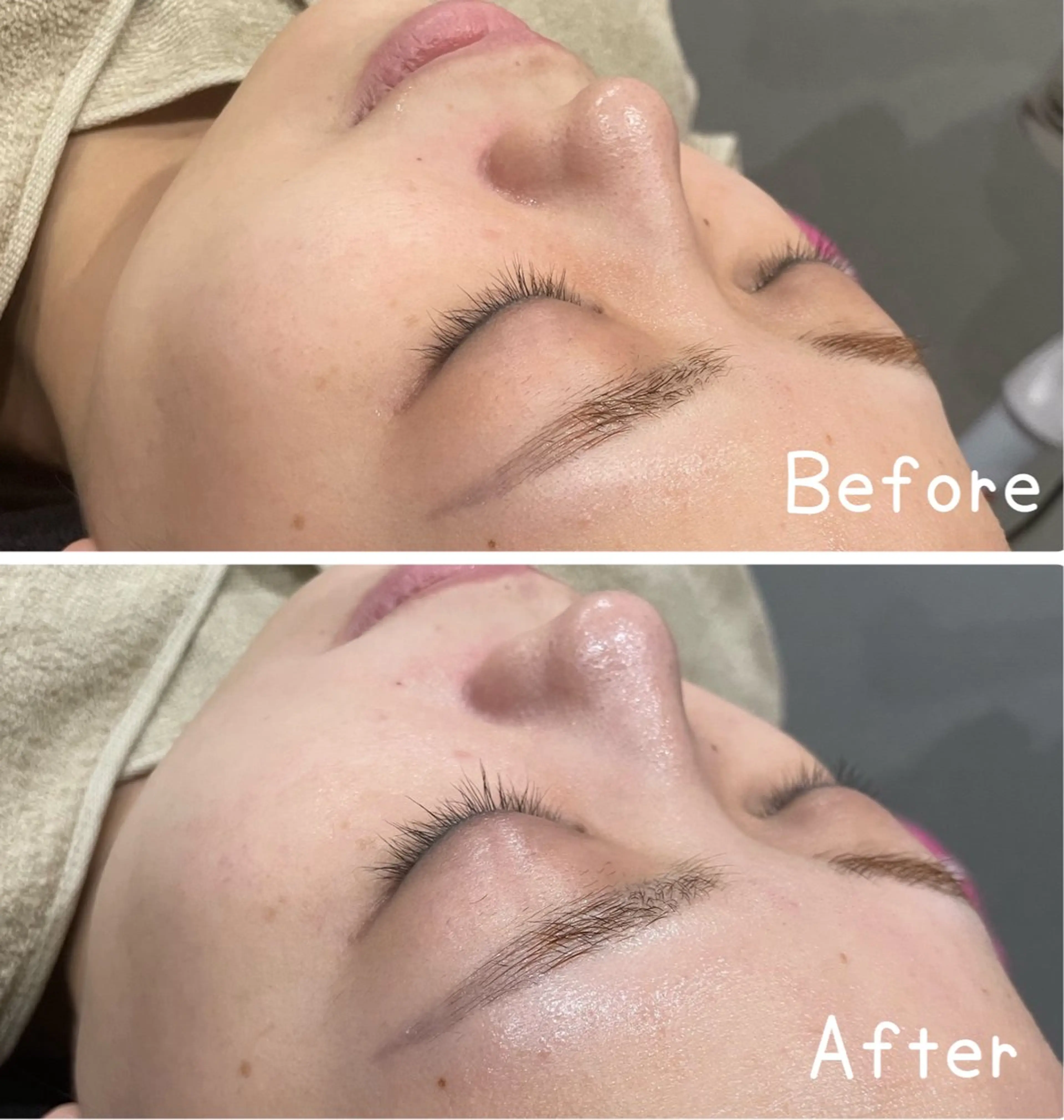 【ミニモ限定】水分爆弾★毛穴レスフェイシャルの写真