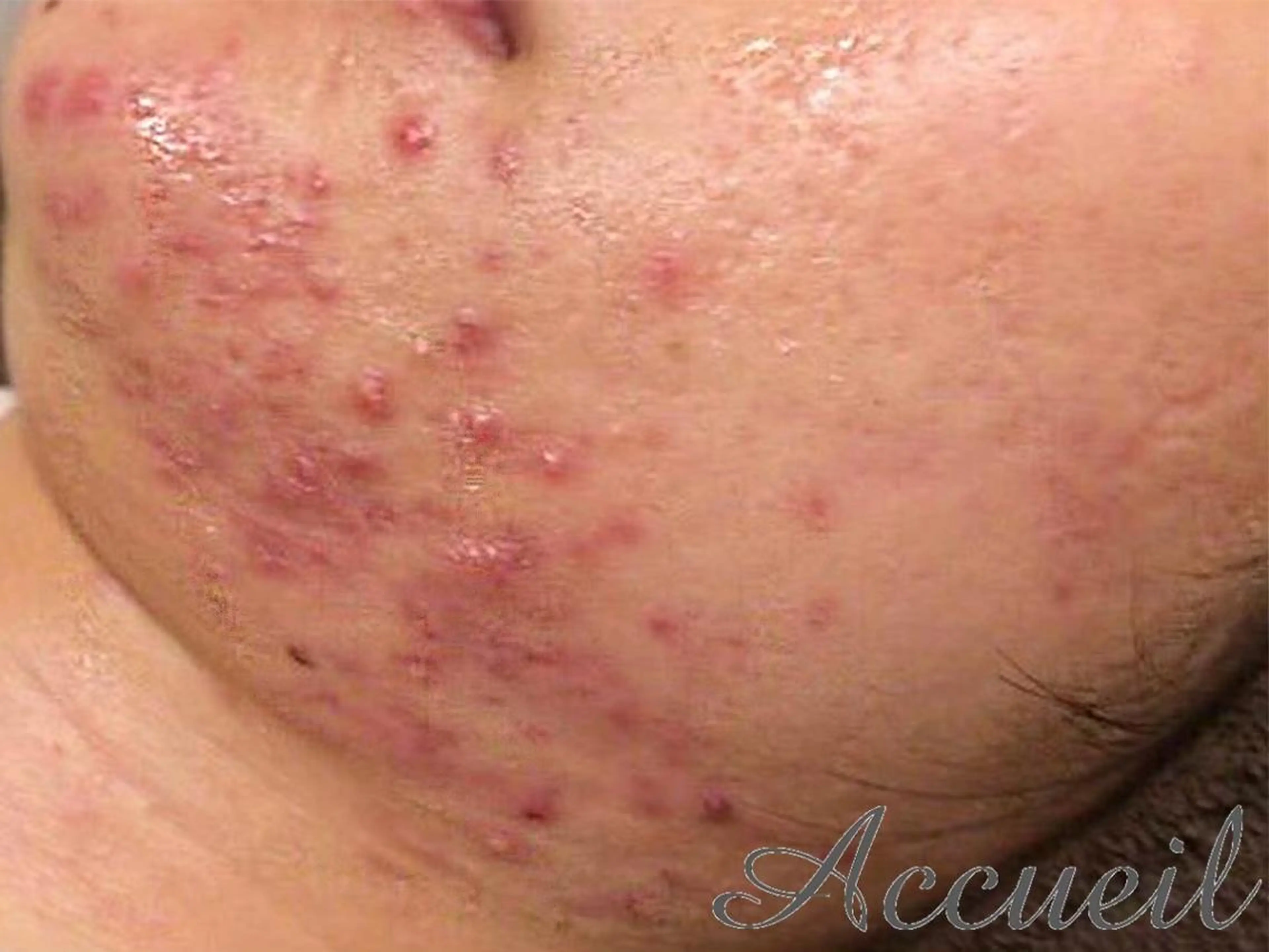 ニキビ特化型エステ 🍓最短で肌質改善のエステ・リラクイメージ