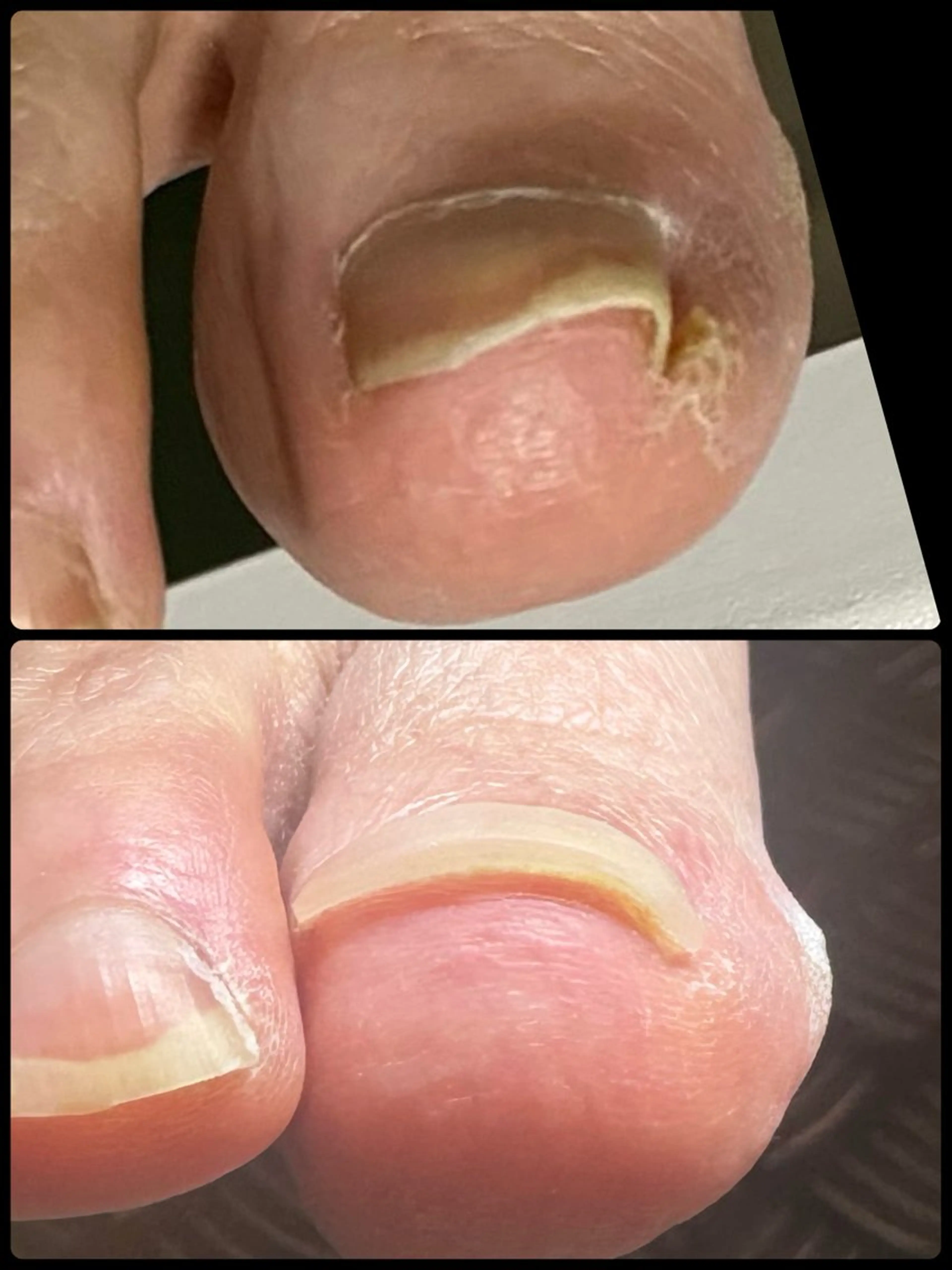 フット巻き爪補正コースの写真