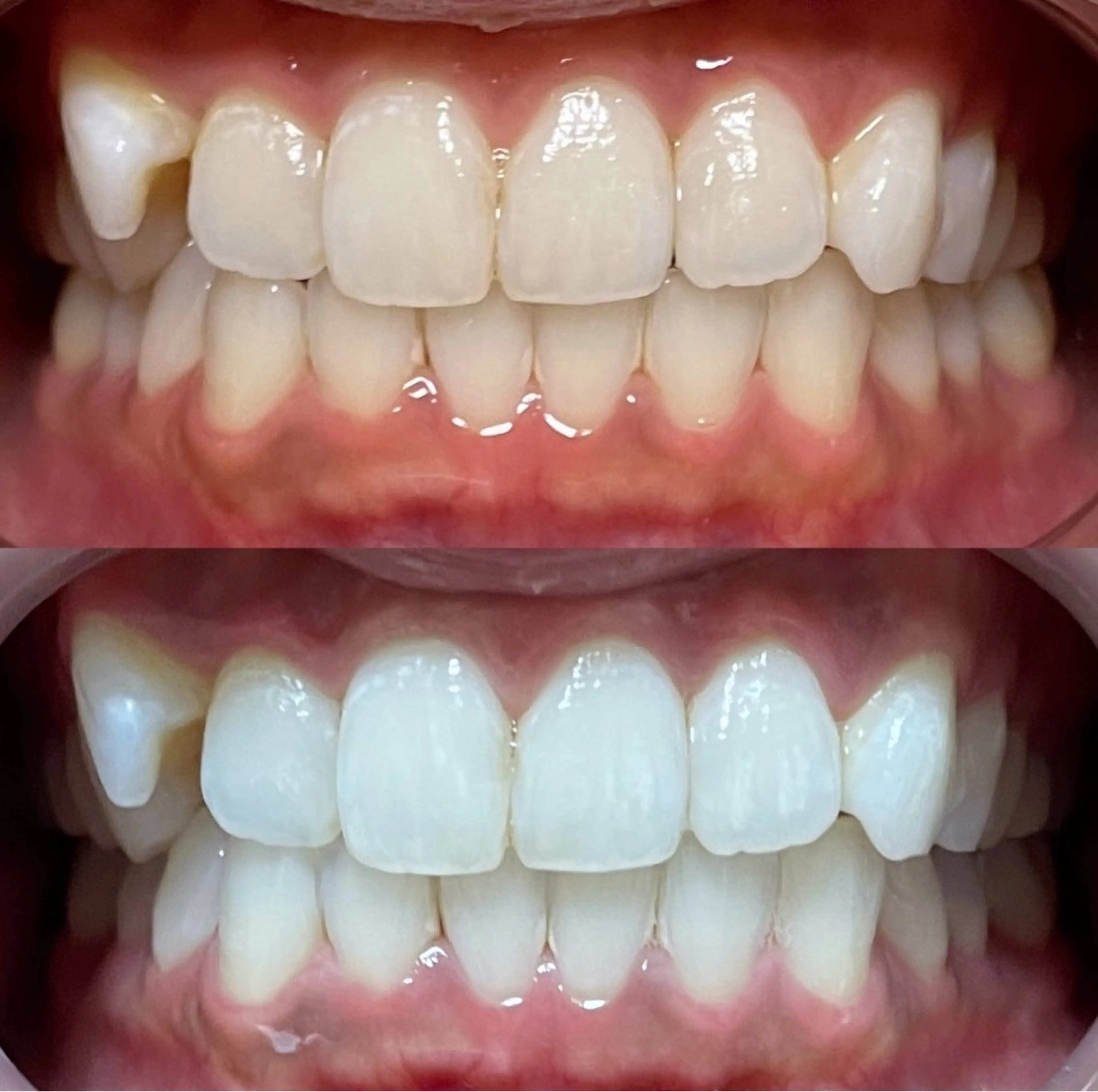 セルフホワイトニング🦷8分×2回照射(空きはリクエストからお問い合わせください)の写真