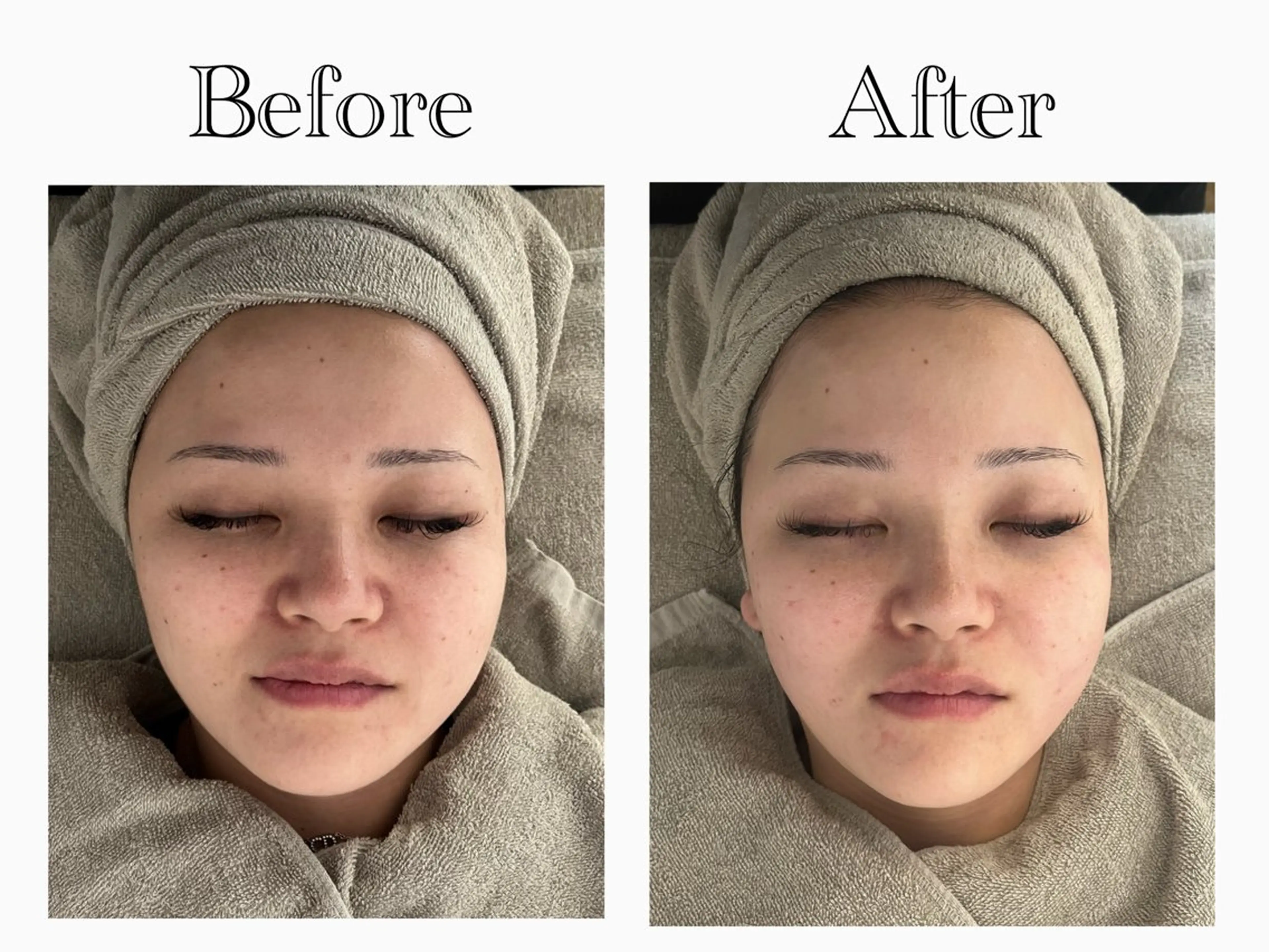 ⭕️半額⭕️(60分)うる艶ジェルパック➕フェイシャルマッサージ【小顔/浮腫み/乾燥/潤い】➕ソフトシェービング産毛ケアの写真