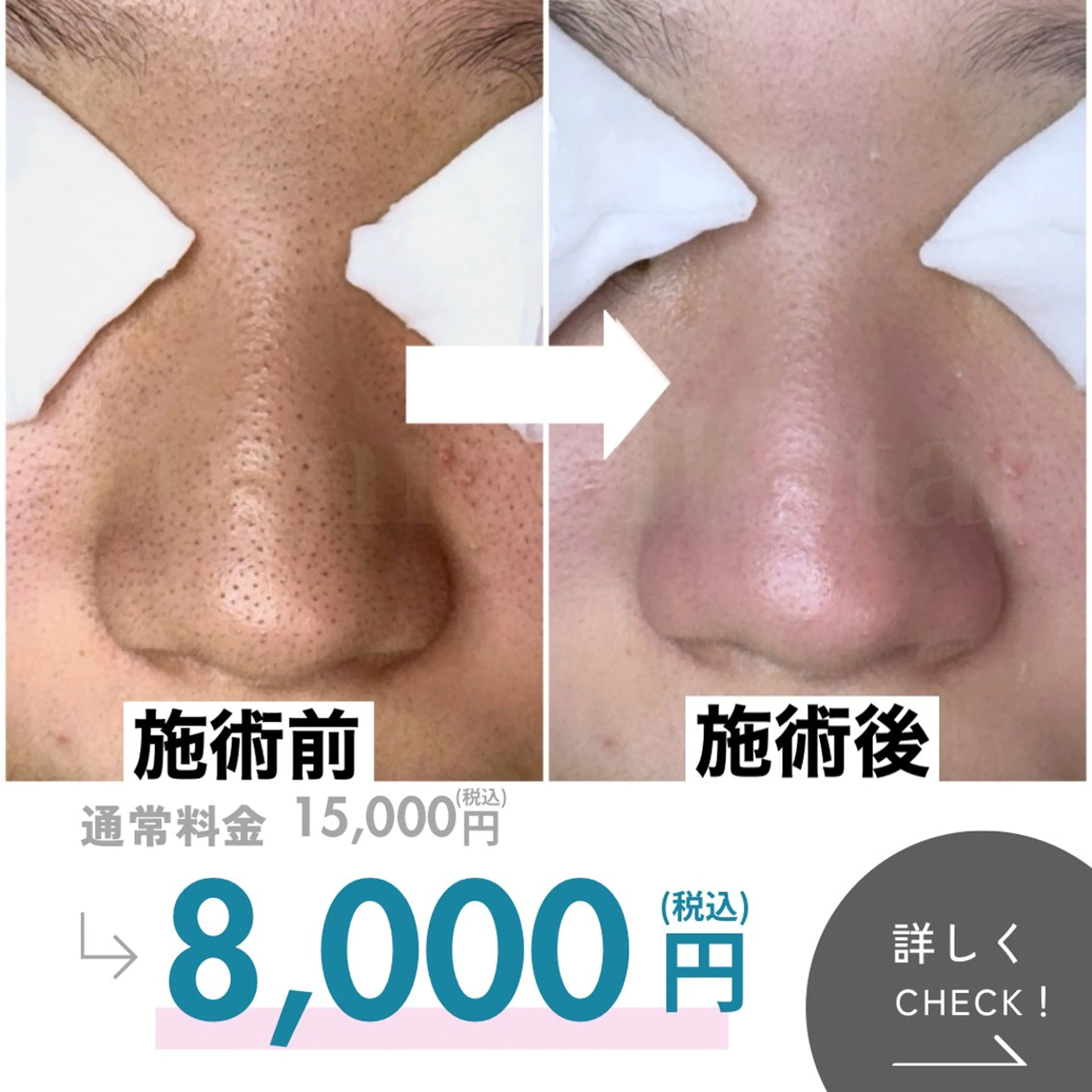 どんな毛穴も綺麗にします!!毛穴徹底改善コースの写真