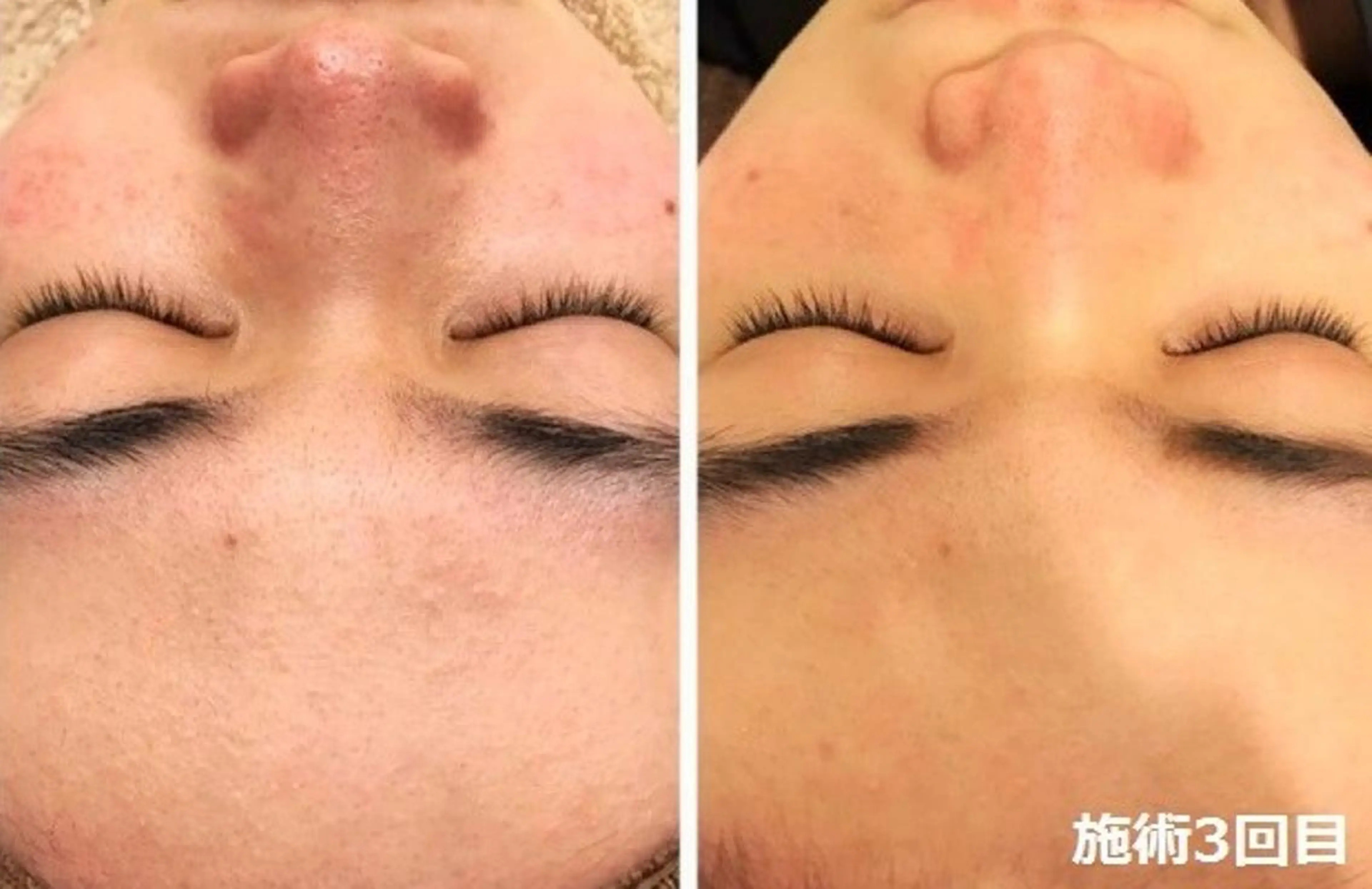 脱毛 顔脱毛＆毛穴＆ニキビ 優良№1♪ヒロコ♪のエステ・リラクイメージ