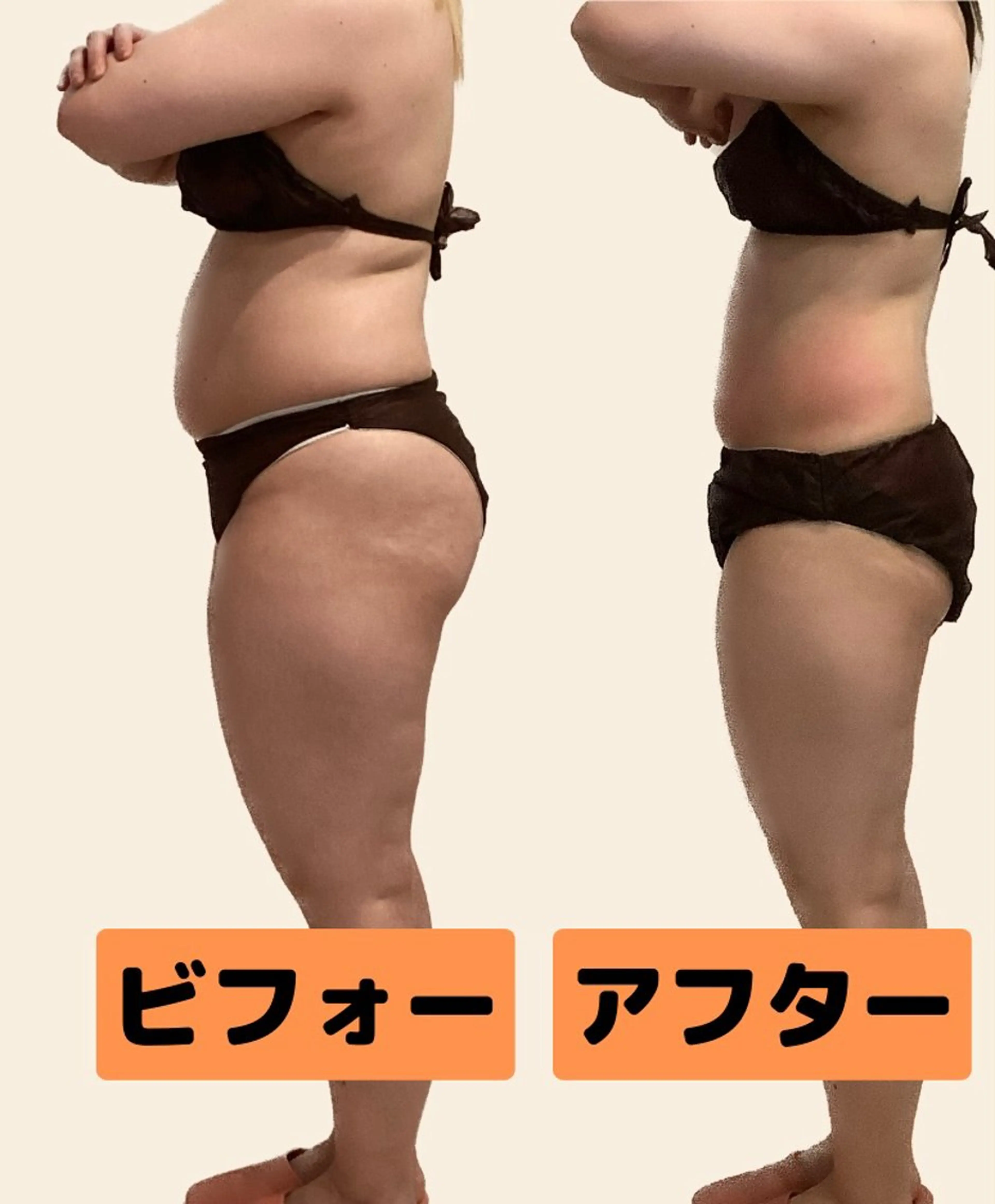 🌟痩身60分🌟後ろ姿美人❗️背中+二の腕+肩+腰回り集中オーダーメイド60分(キャビ+ラジオ波+吸引/EMS)の写真