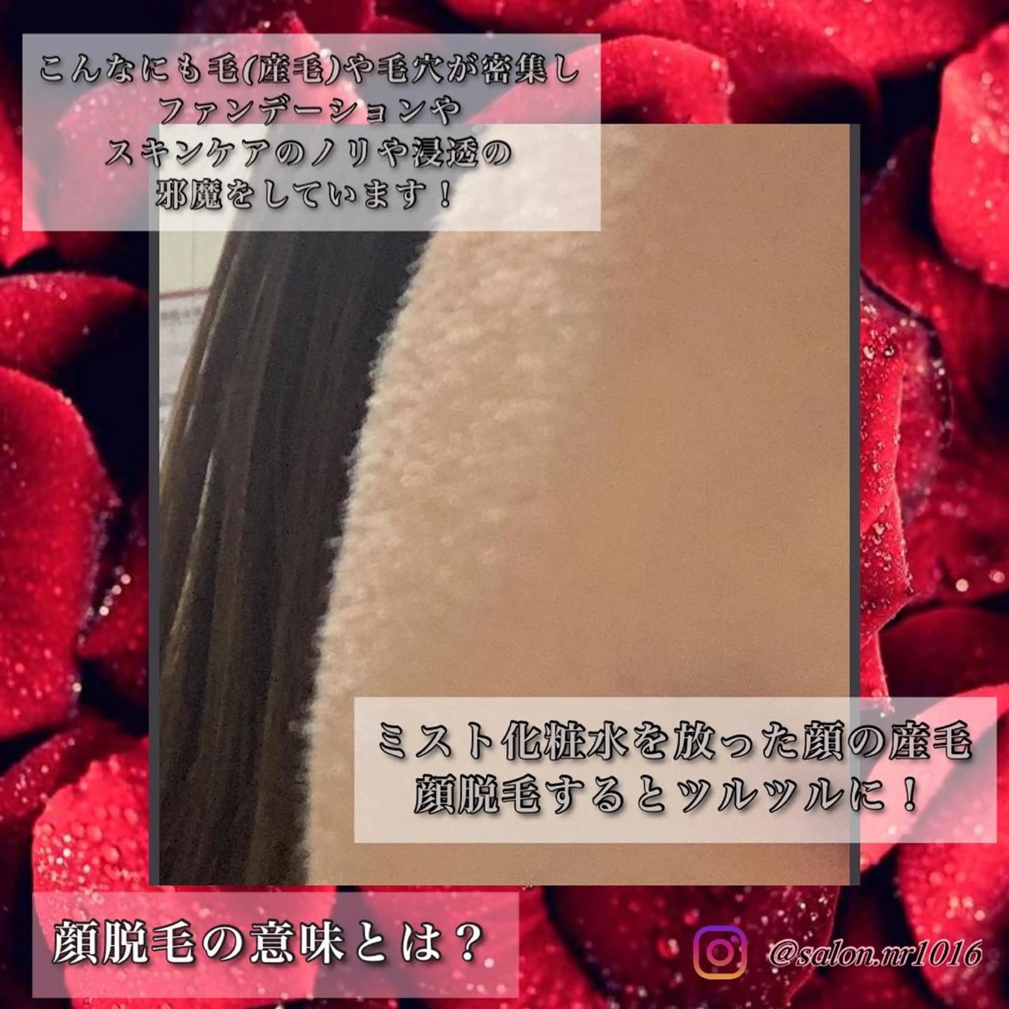 脱毛 脱毛サロン NR エヌアール所属・NR Nara yukiのエステ・リラクイメージ