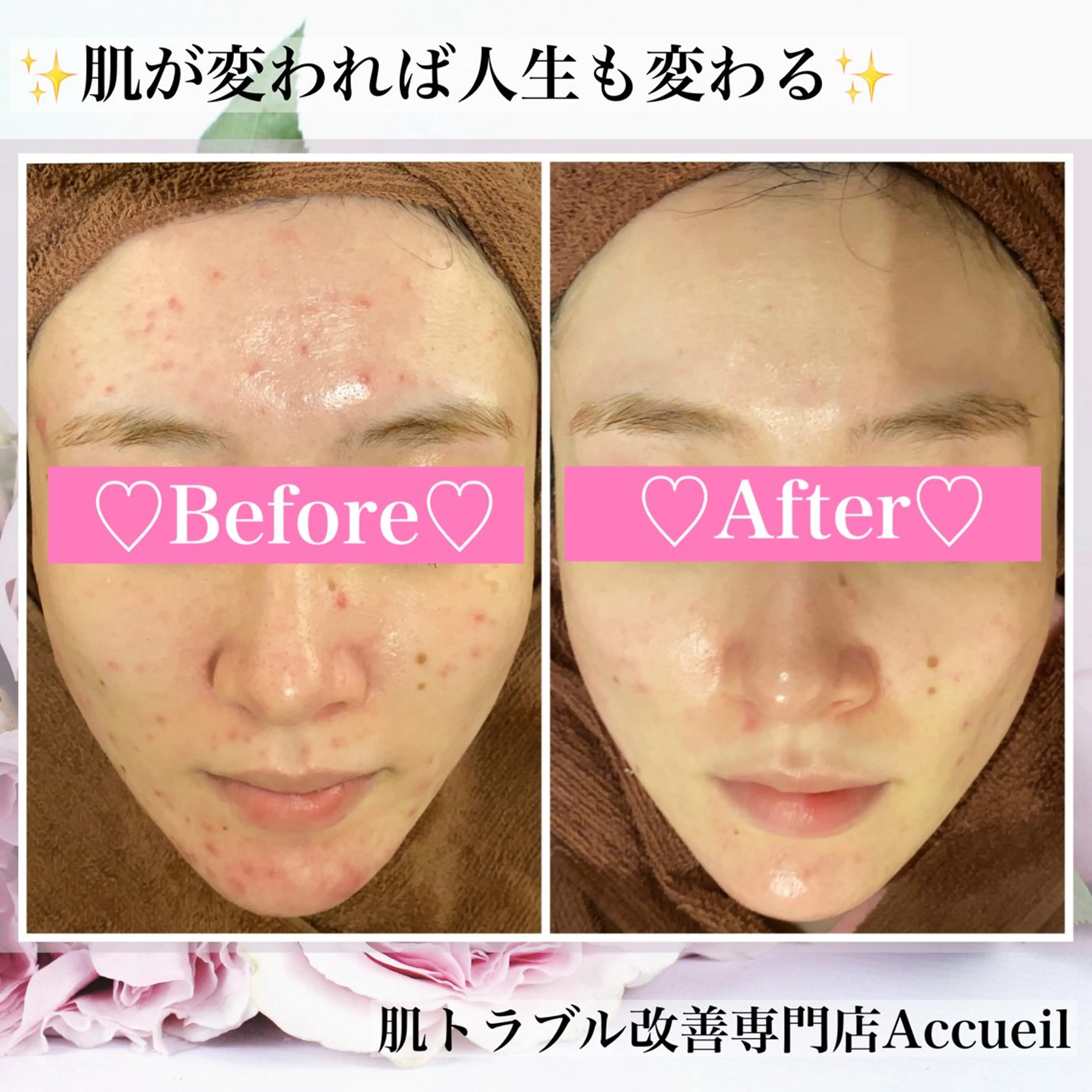 エステ リラク ニキビ・肌質改善専門 ♡人生が変わるサロンのエステ・リラクイメージ