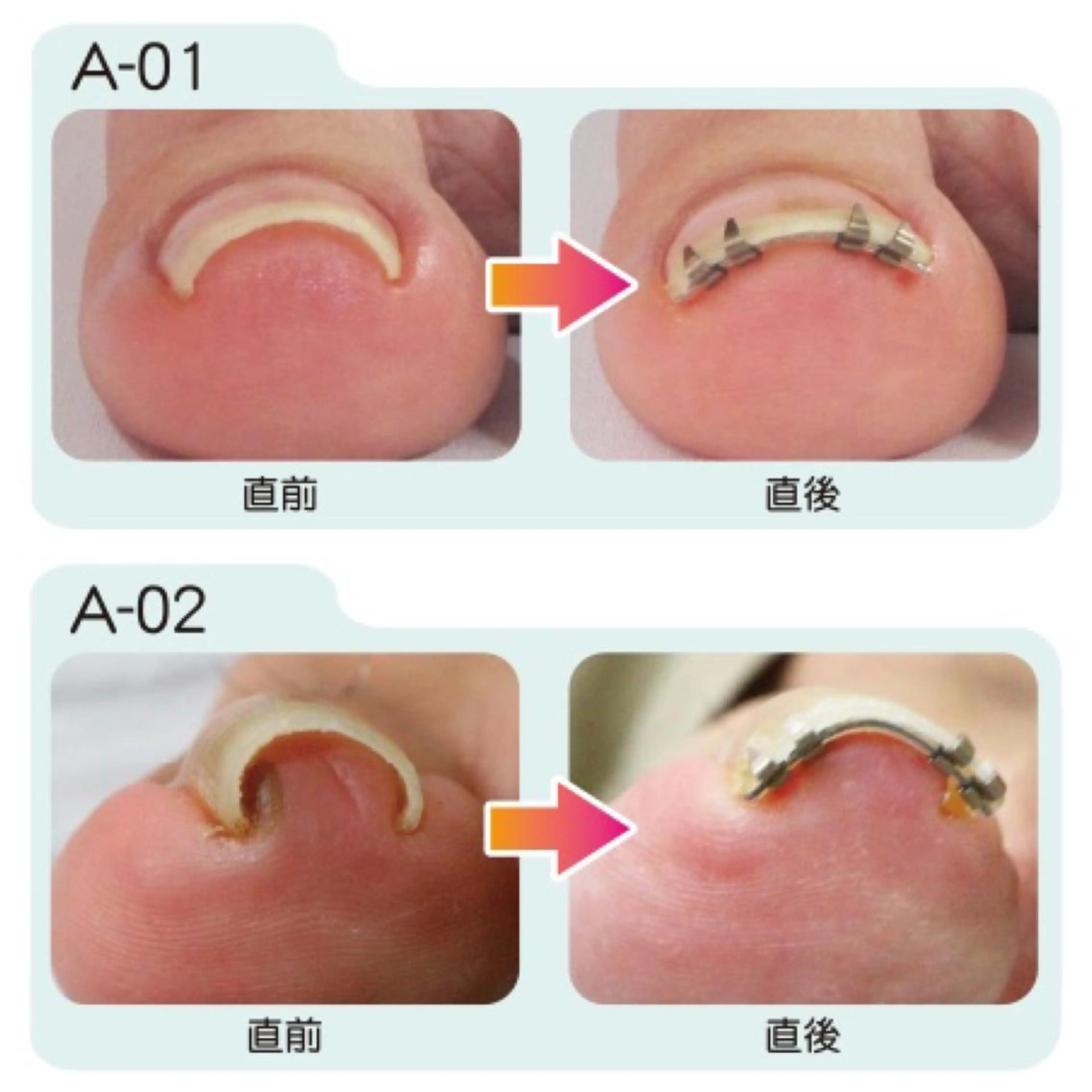 【巻き爪矯正1本(クリアジェル仕上げ)】フットバス、丁寧ケア、矯正装具込みの写真