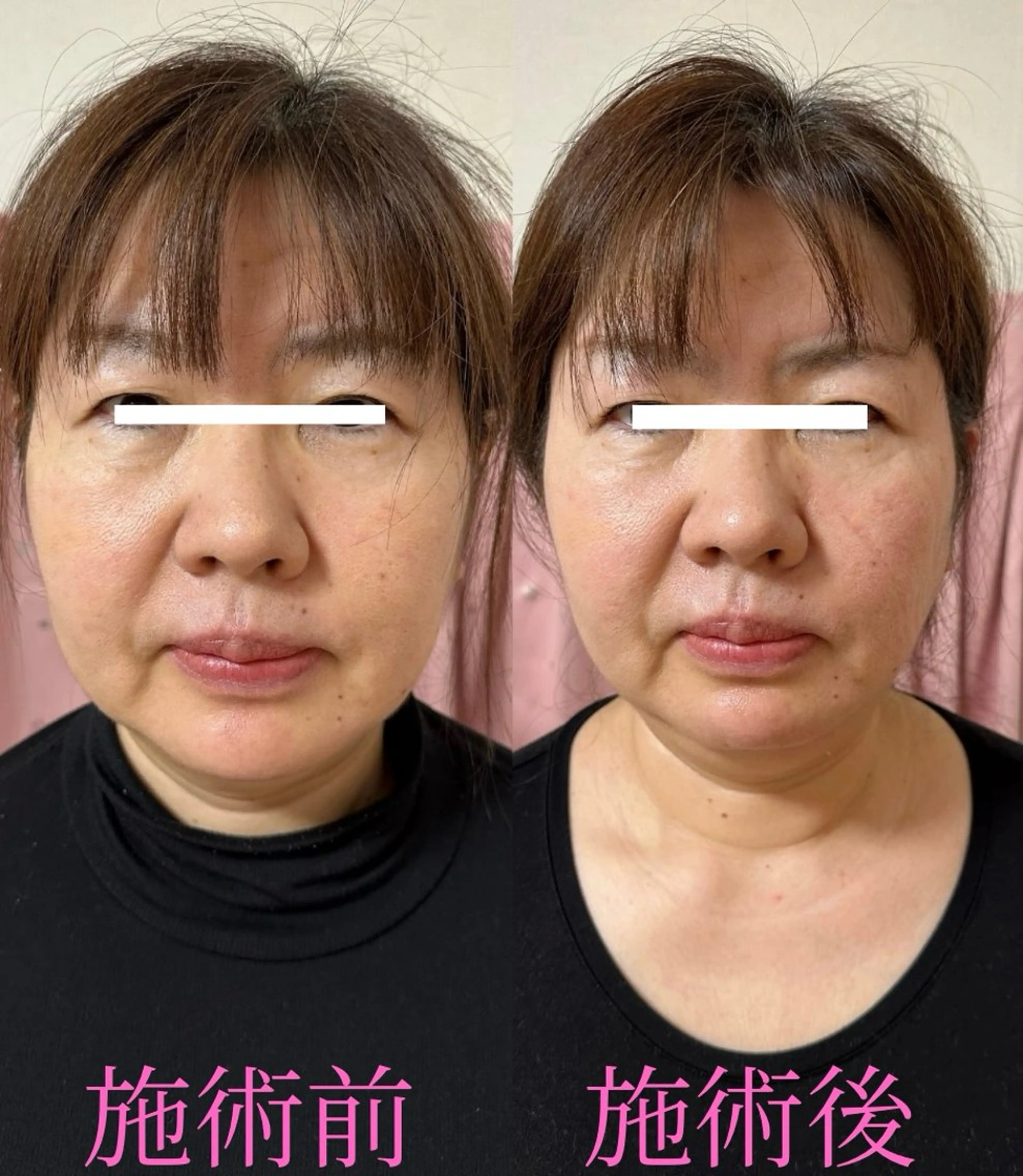 痩身・小顔・骨盤矯正×ヒップアップ専門エステ Peach所属・桃尻つかさ🍑小顔× ノーファンデ肌作りのエステ・リラクイメージ