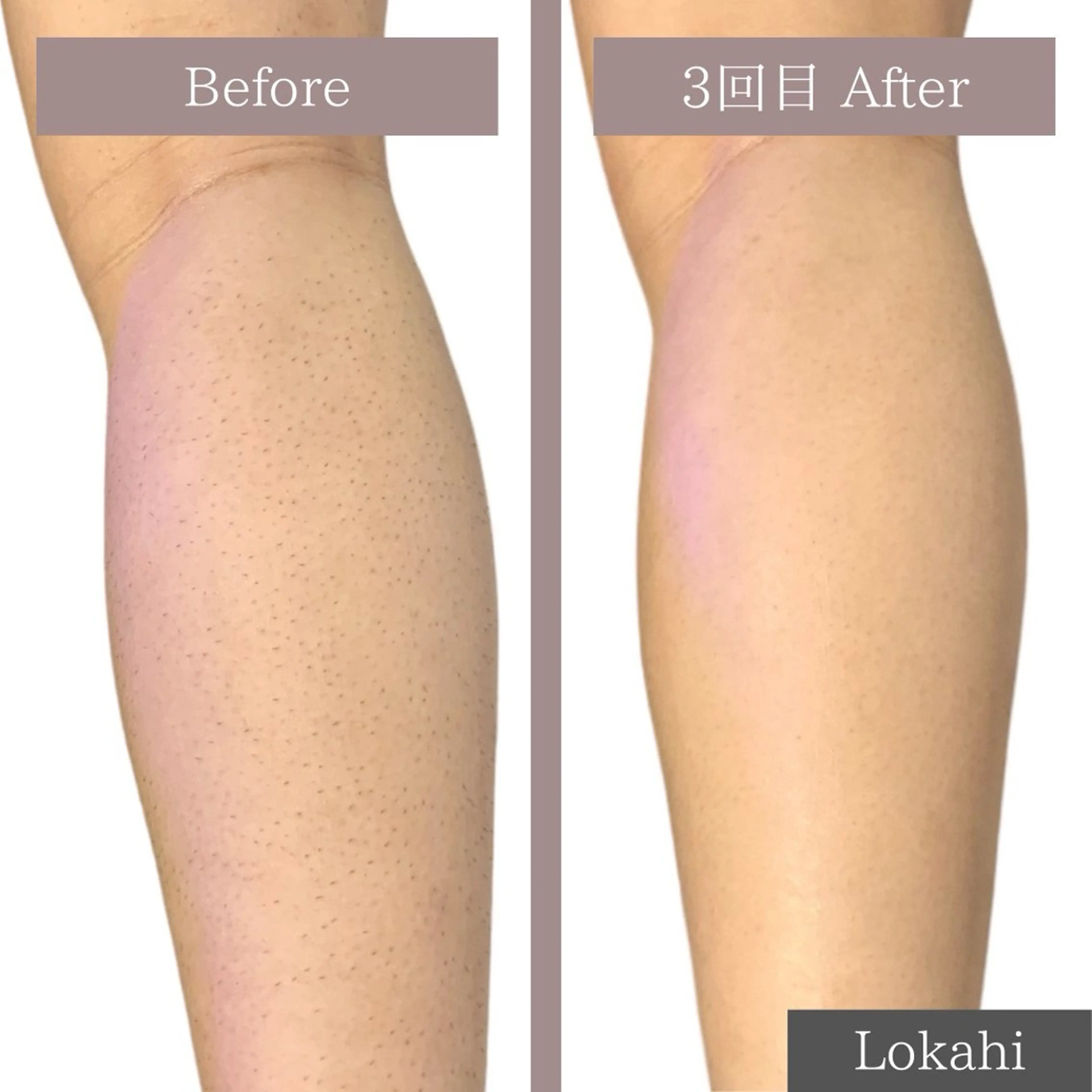 脱毛 Lokahi所属・脱毛サロン Lokahiのエステ・リラクイメージ