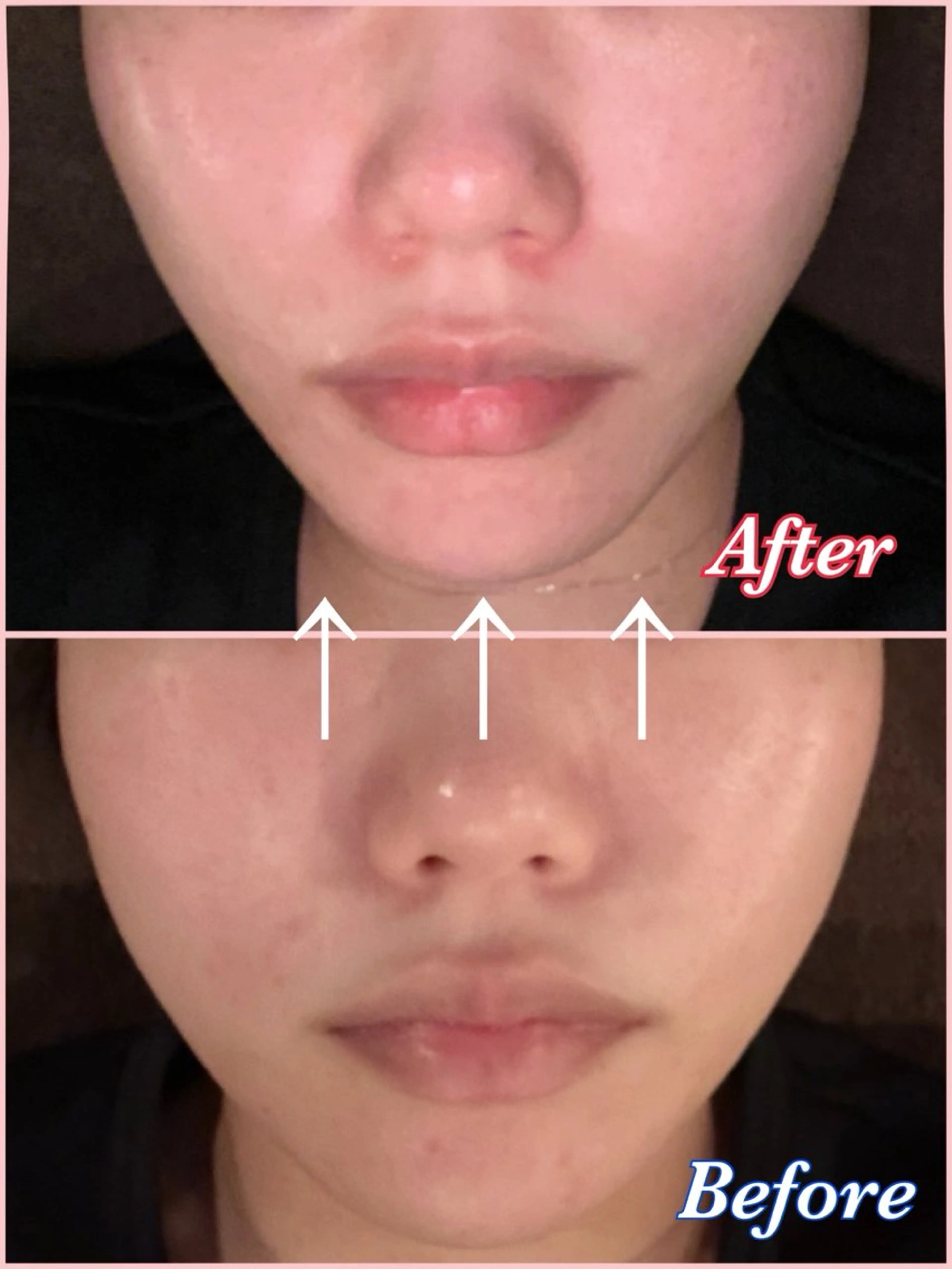 小顔&美肌のW効果❤️『超音波エステ』の写真