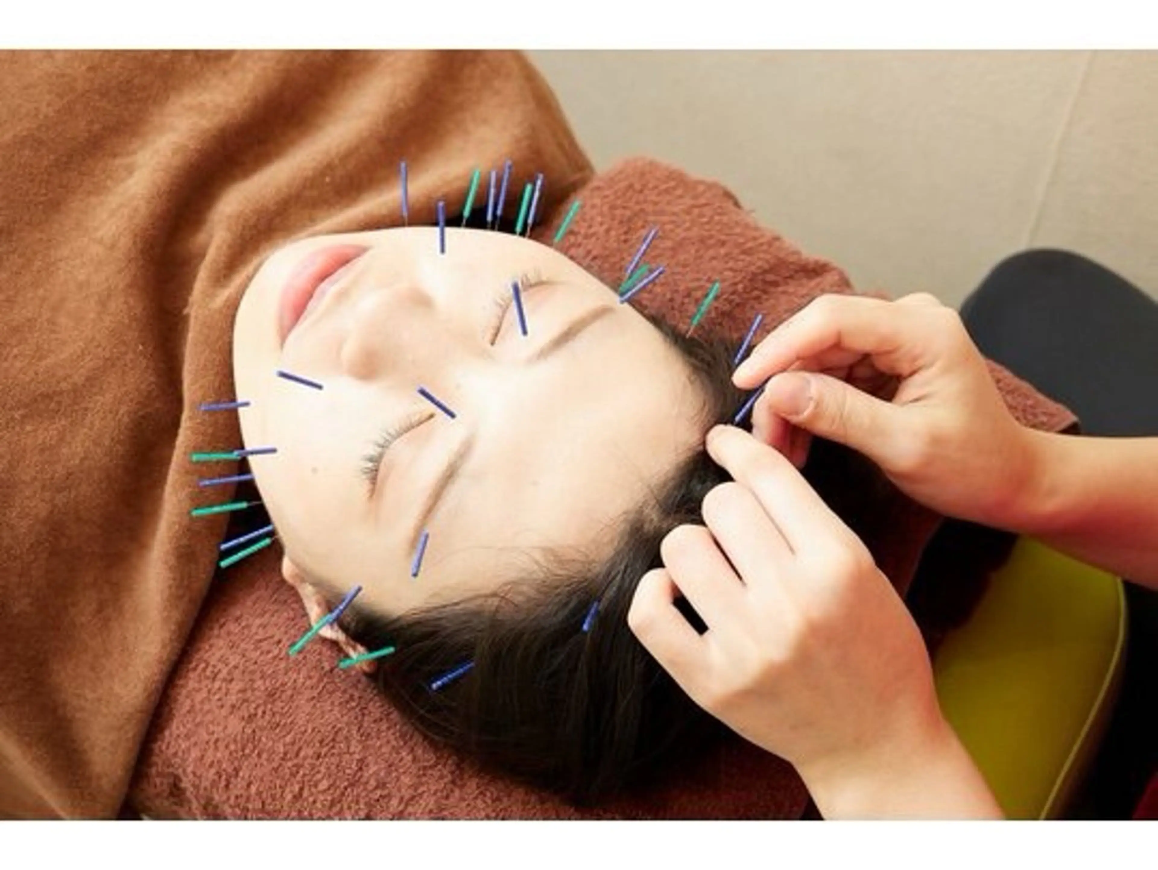 ✨美容鍼灸✨プルップルのお肌へ🫧肌荒れやリフトアップ⤴️の写真