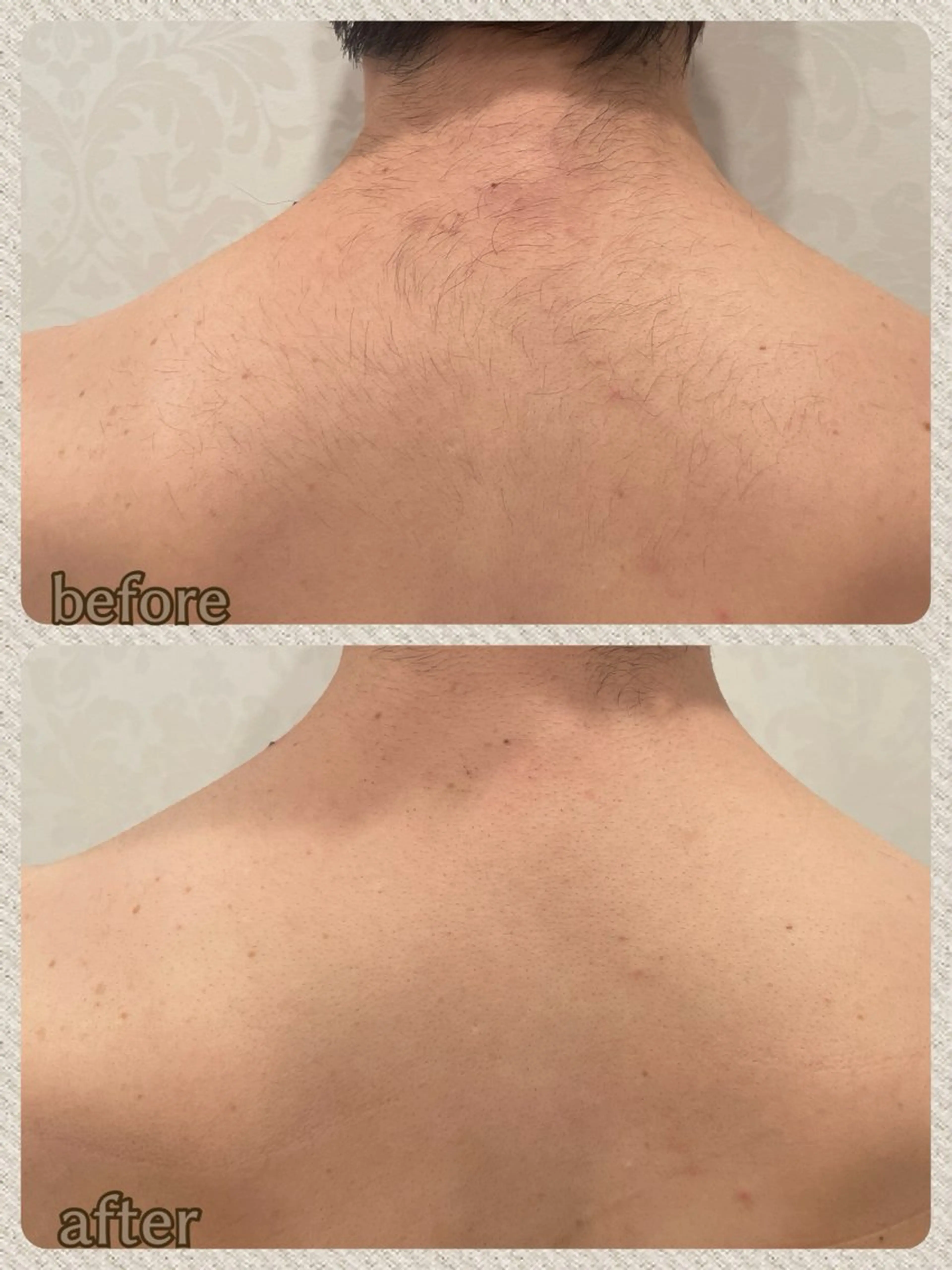 【脱毛】上半身背面パック/¥6600→¥4400の写真