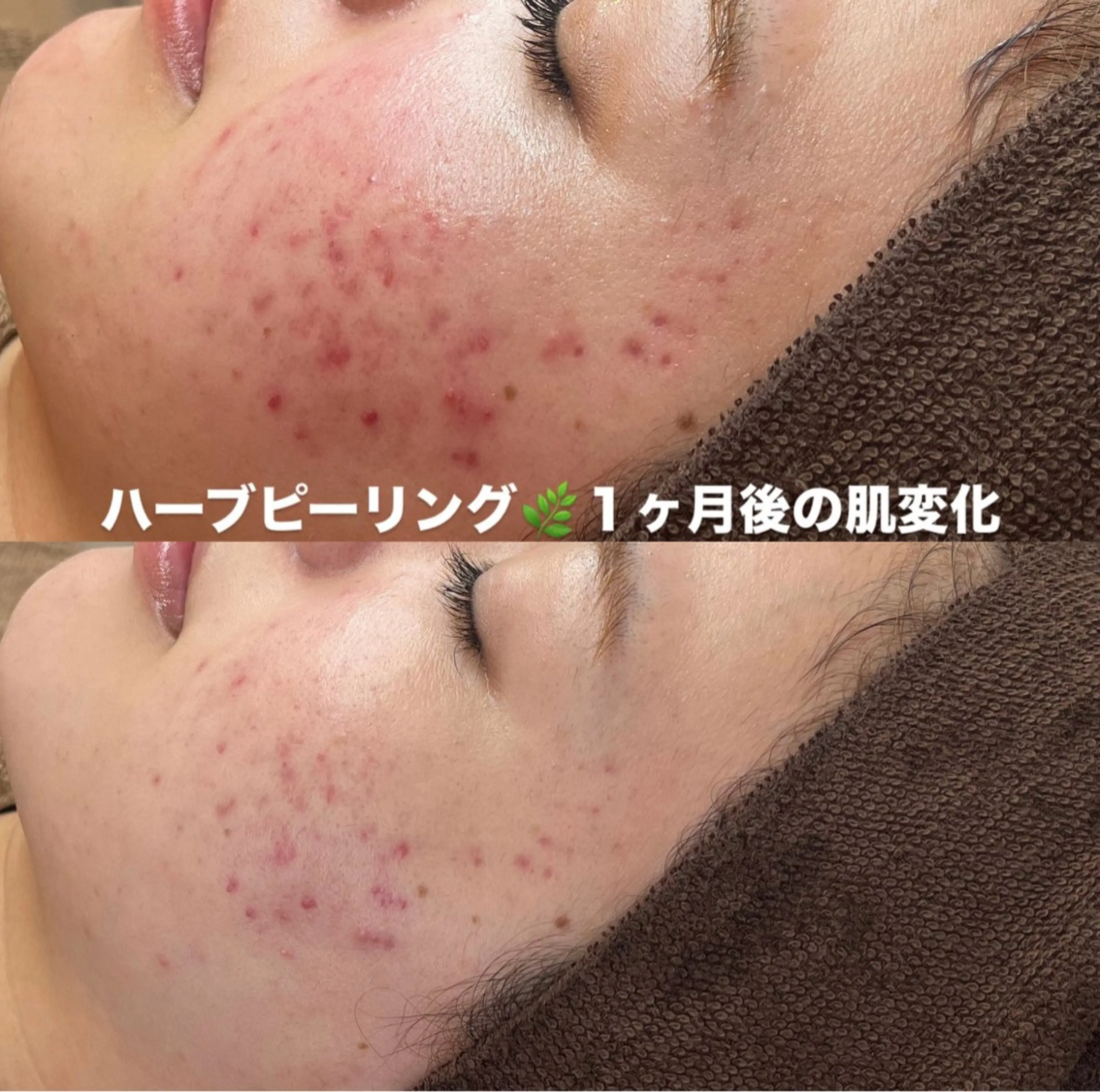 エステ BELLIS HUIT所属・ハーブピーリング那覇 BELLISHUITのエステ・リラクイメージ