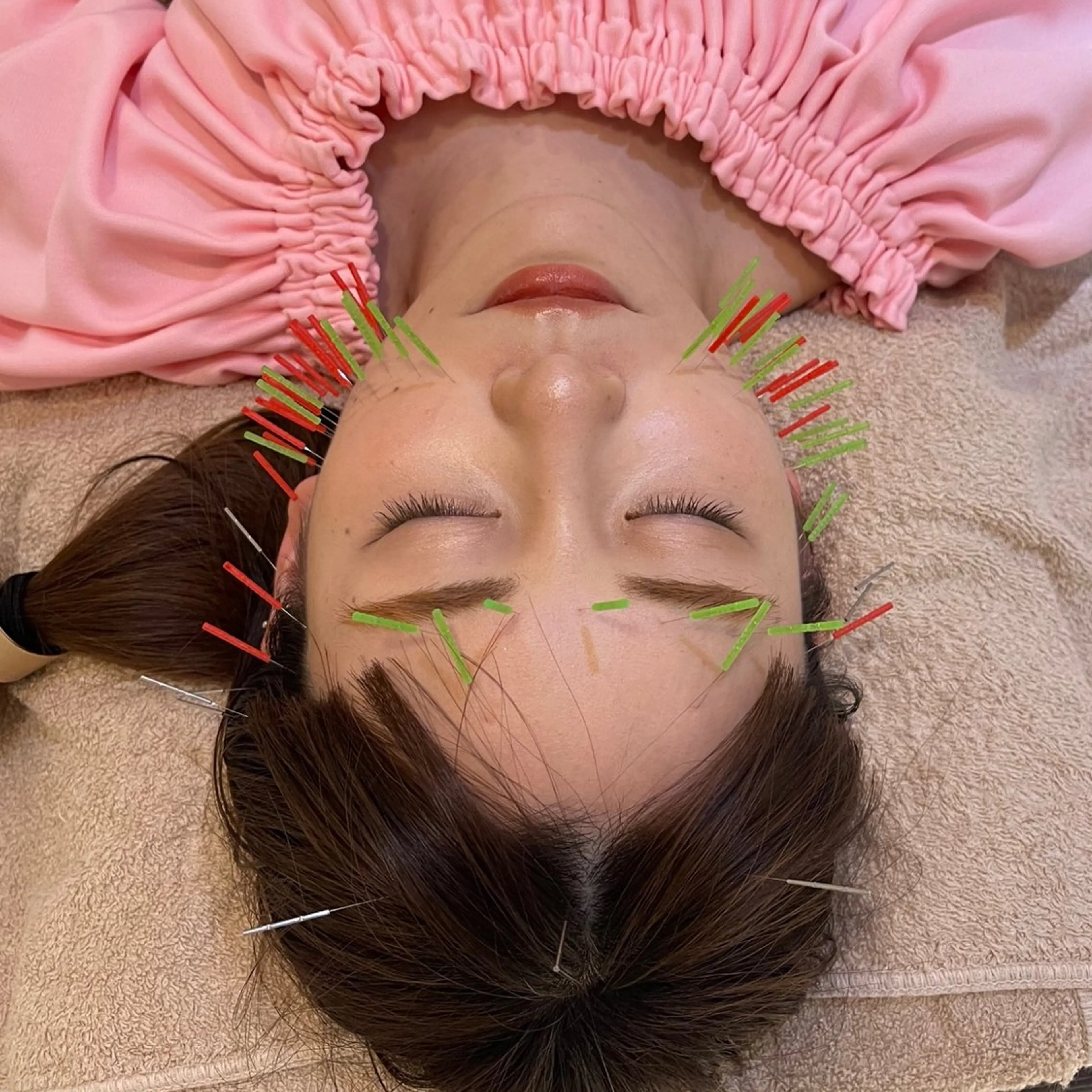 🪡ミニモ限定🪡【小顔になりたい方】美容鍼 50分の写真