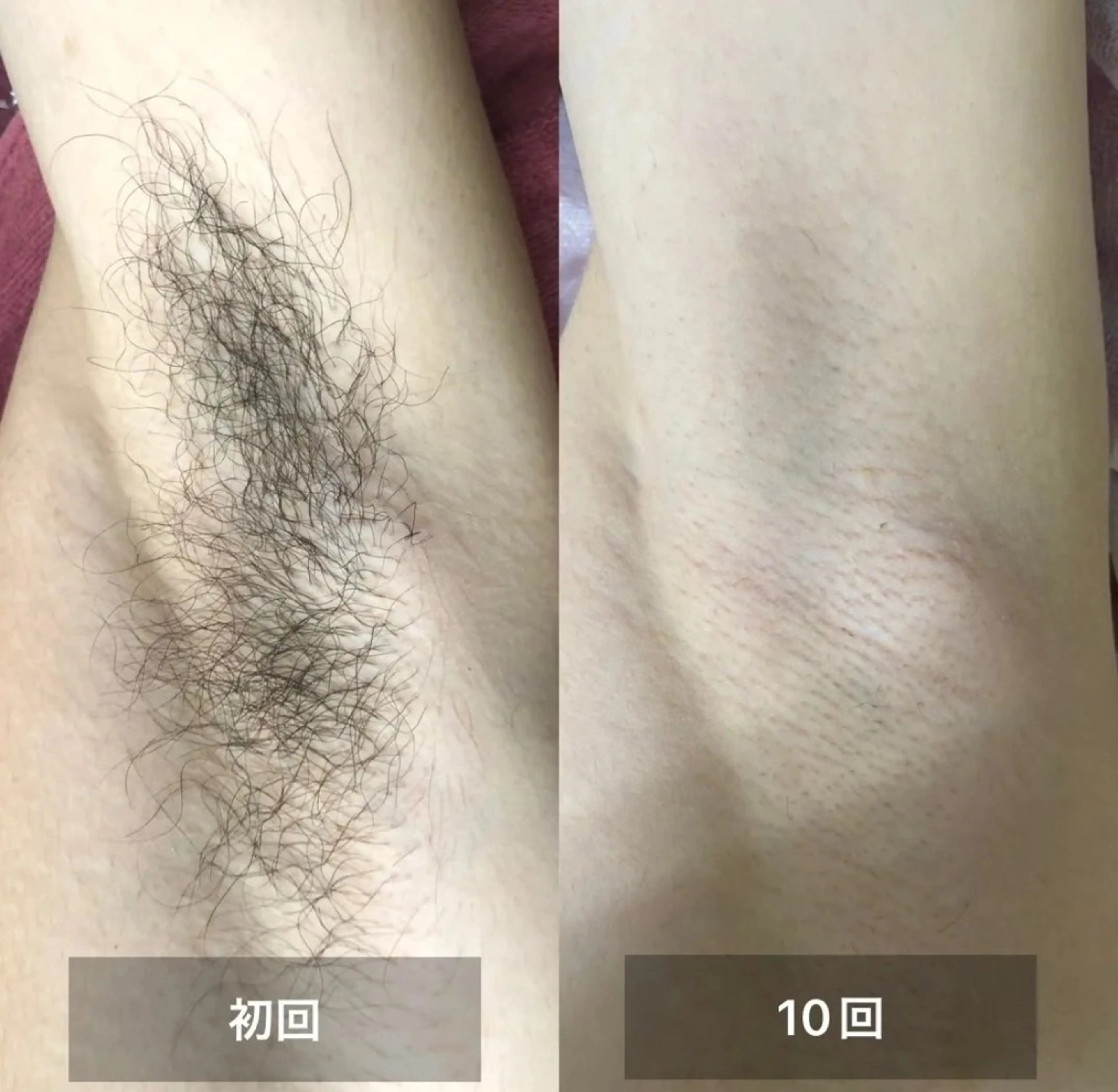 脱毛 Uruka関本 ふみ佳のエステ・リラクイメージ