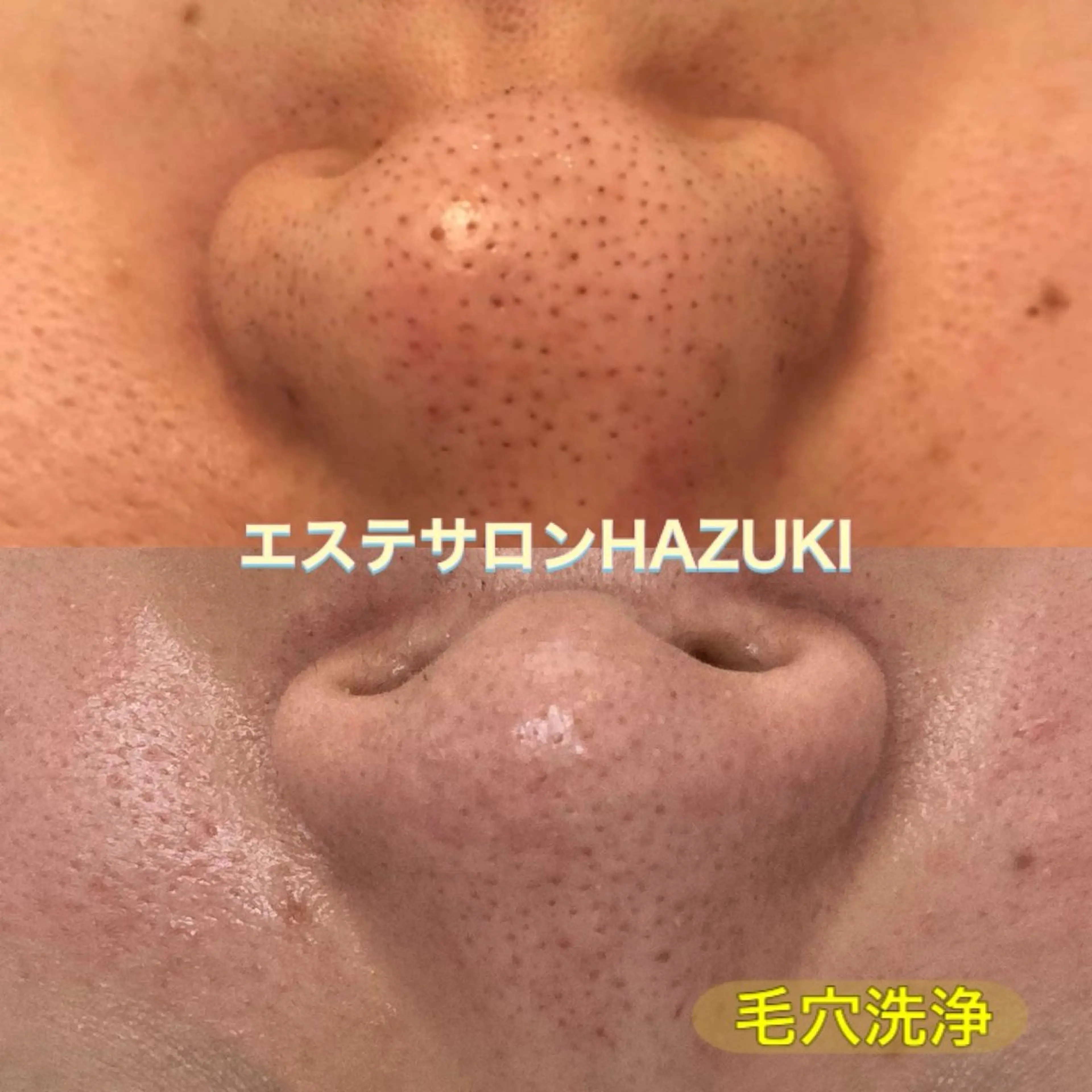 ミニモ先行　お肌にありがとうキャンペーン【お肌の大掃除】えっ！こんなに！毛穴汚れ&老廃物をごっそり除去の写真