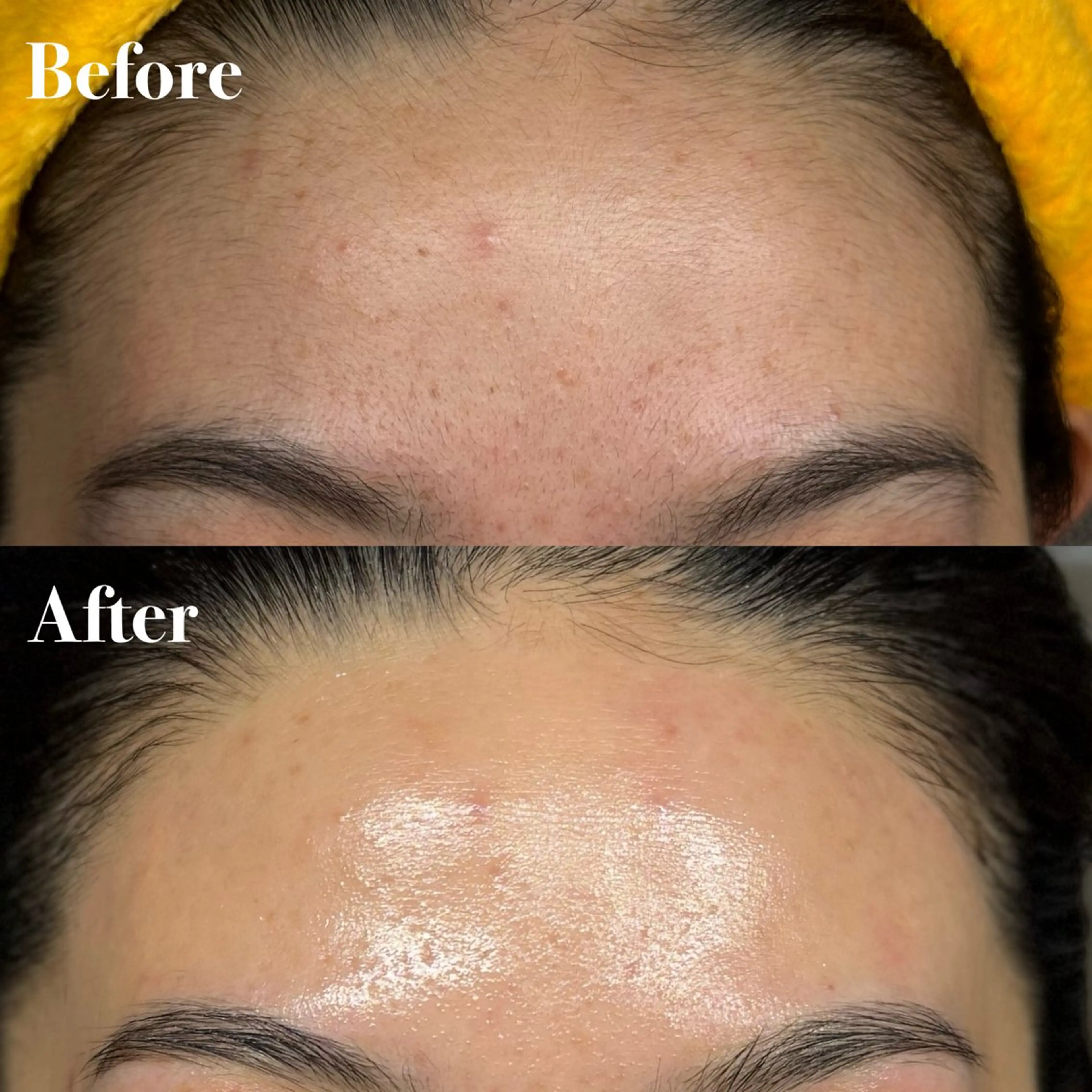 フェイシャルwax脱毛　クリニックレベルエクソソーム導入付きの写真