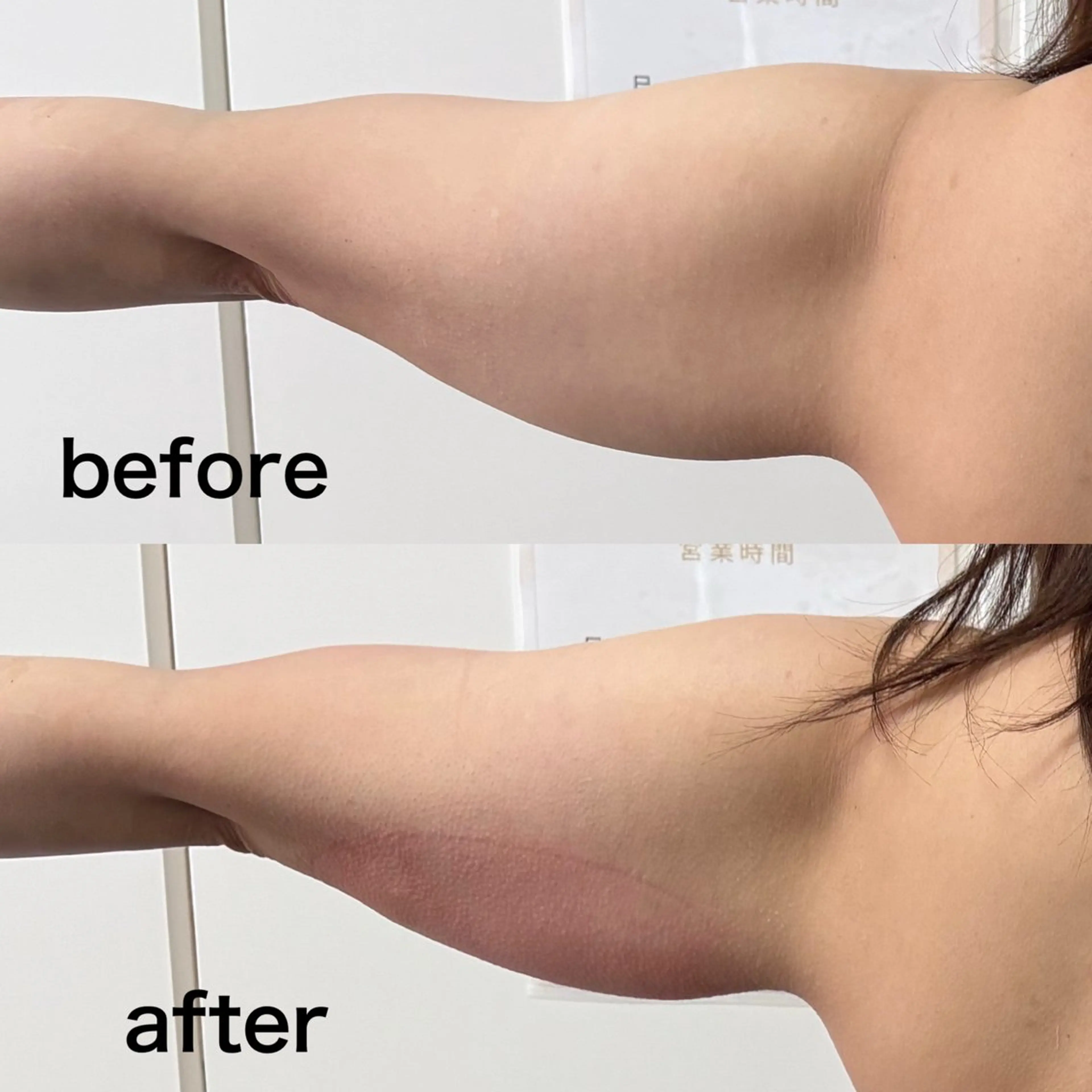 エステ Miiju.所属・Miiju. 石巻市 脂肪冷却  鈴木のエステ・リラクイメージ