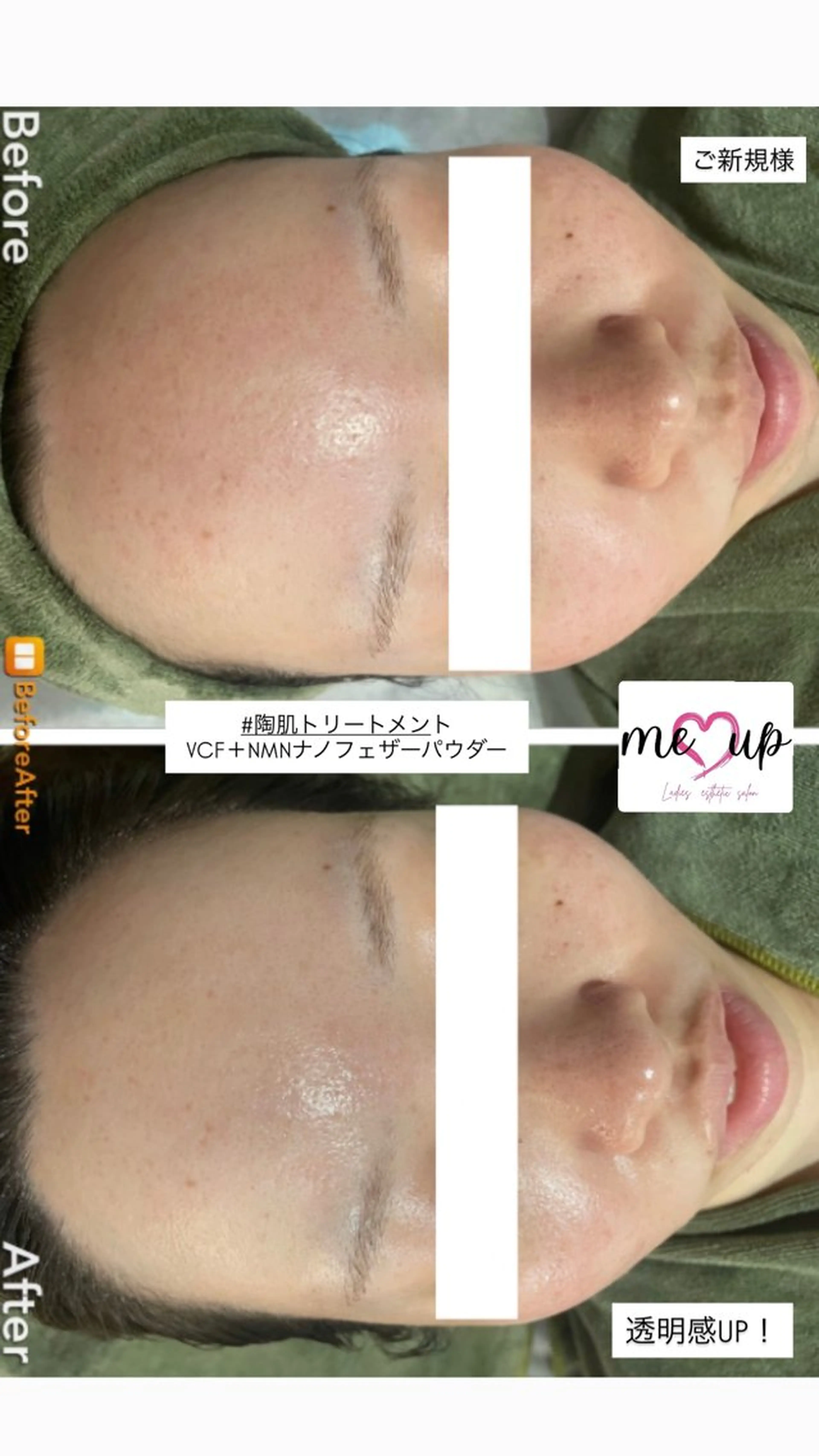 エステ Meupニキビ専門店 背中/ハーブ/肌管理のその他イメージ